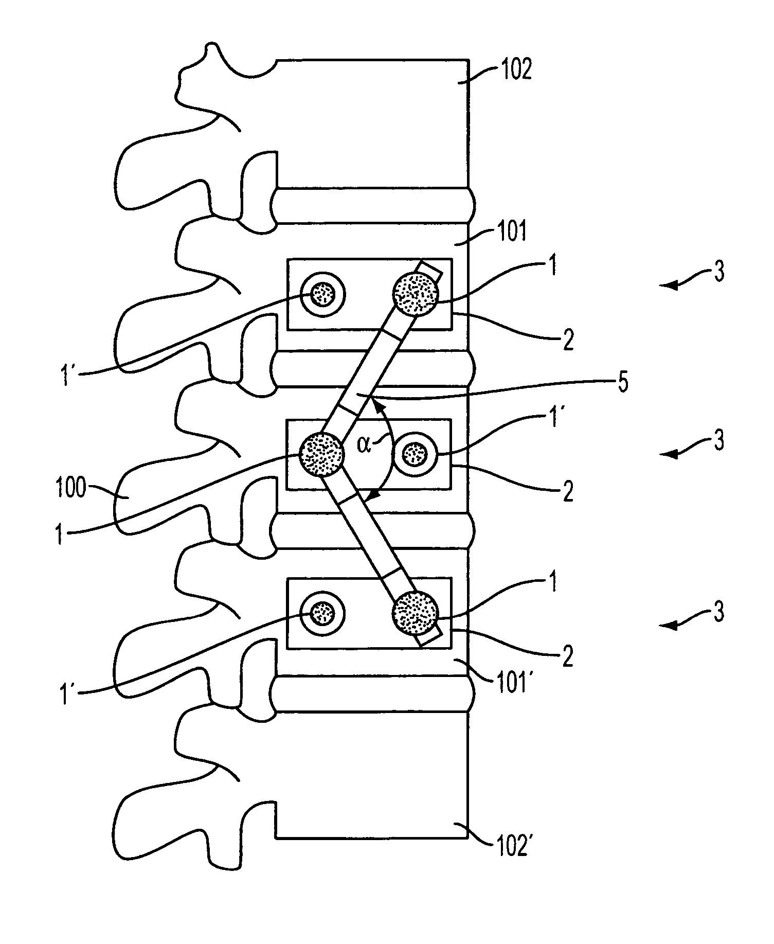 Device and method for dynamic spinal fixation for correction of spinal deformities