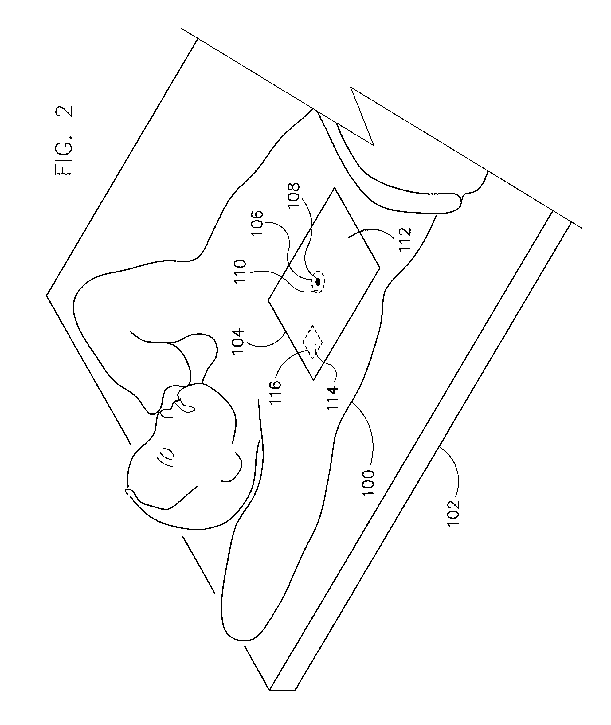 Method and apparatus for correcting distortion in MR images caused by metallic implants