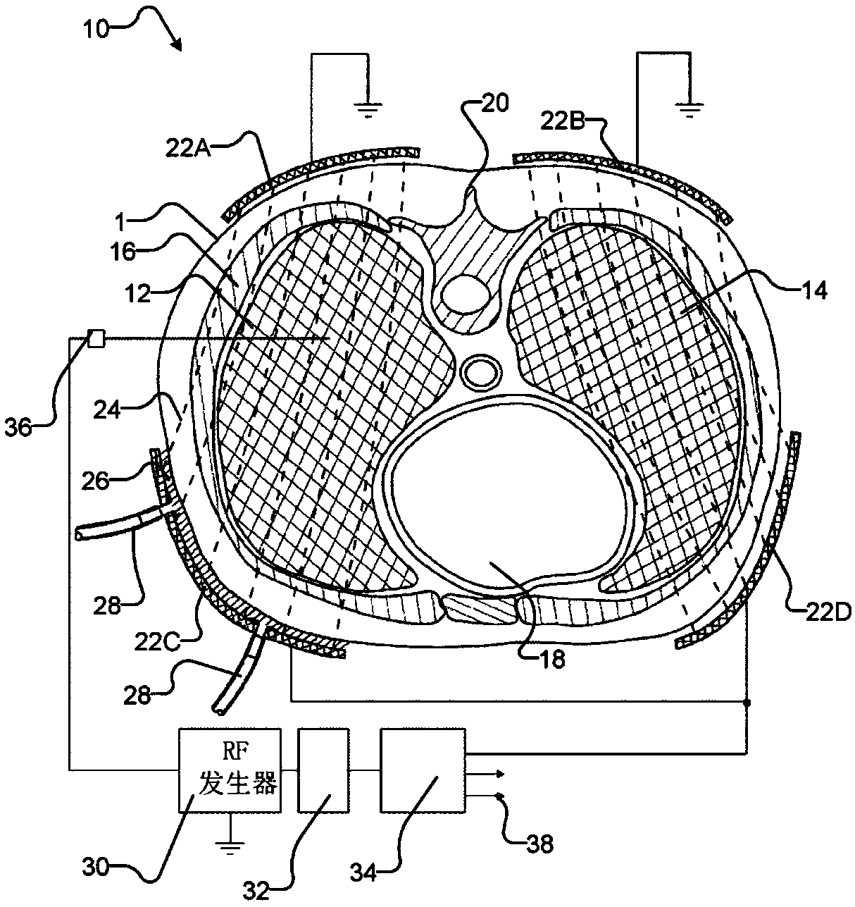 System for treating unwanted tissue