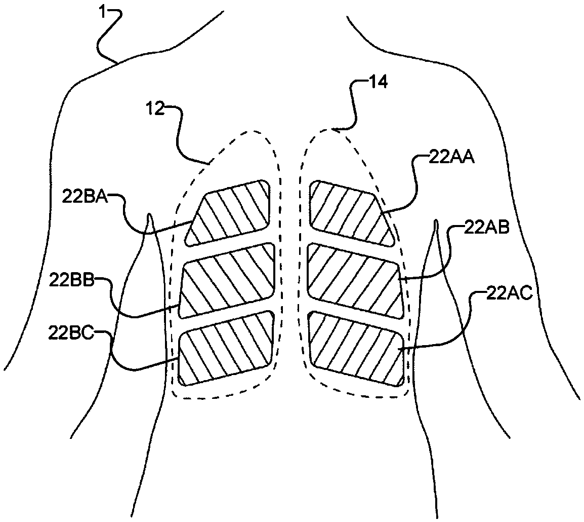 System for treating unwanted tissue