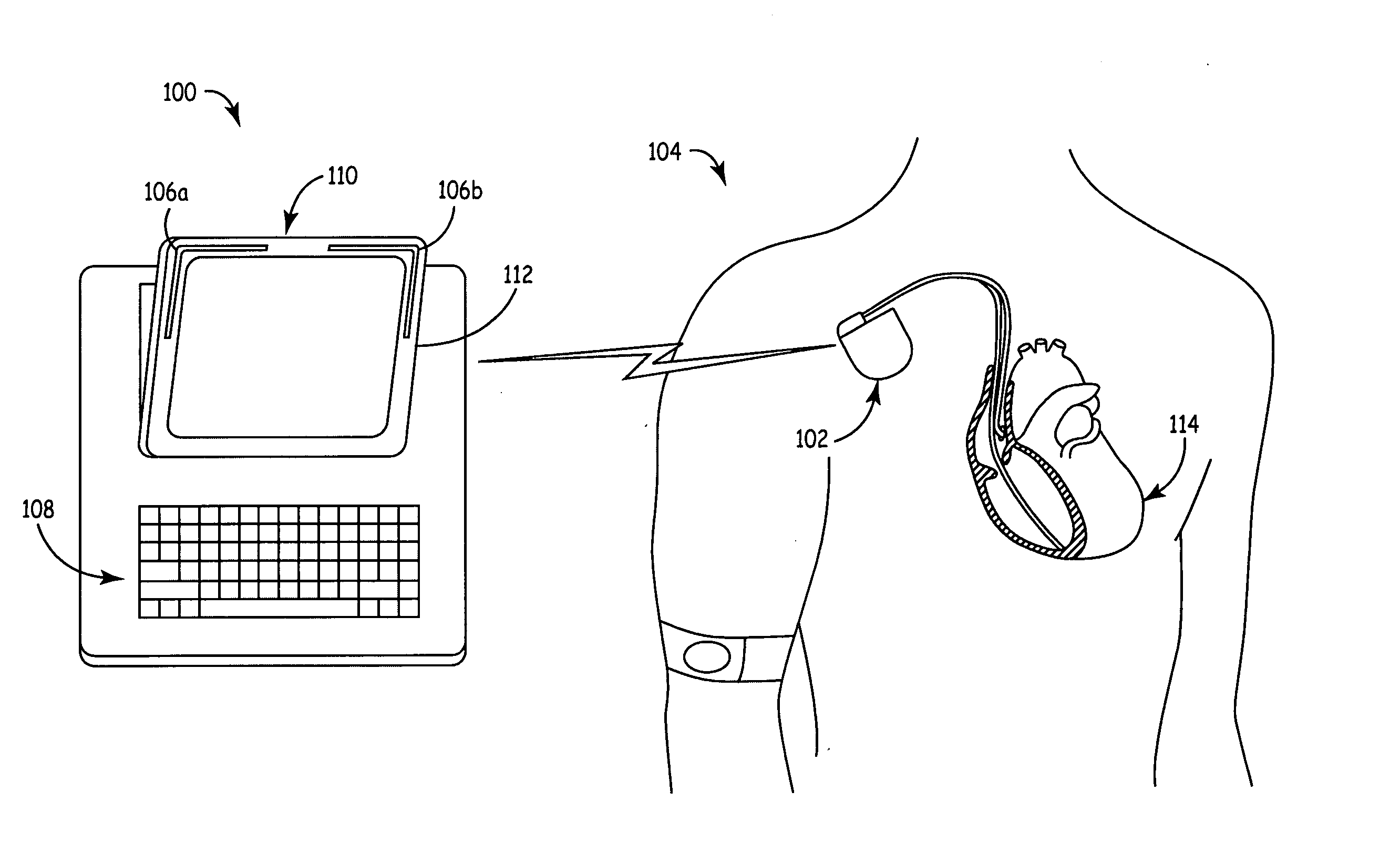 Compact conformal antenna for a medical telemetry system