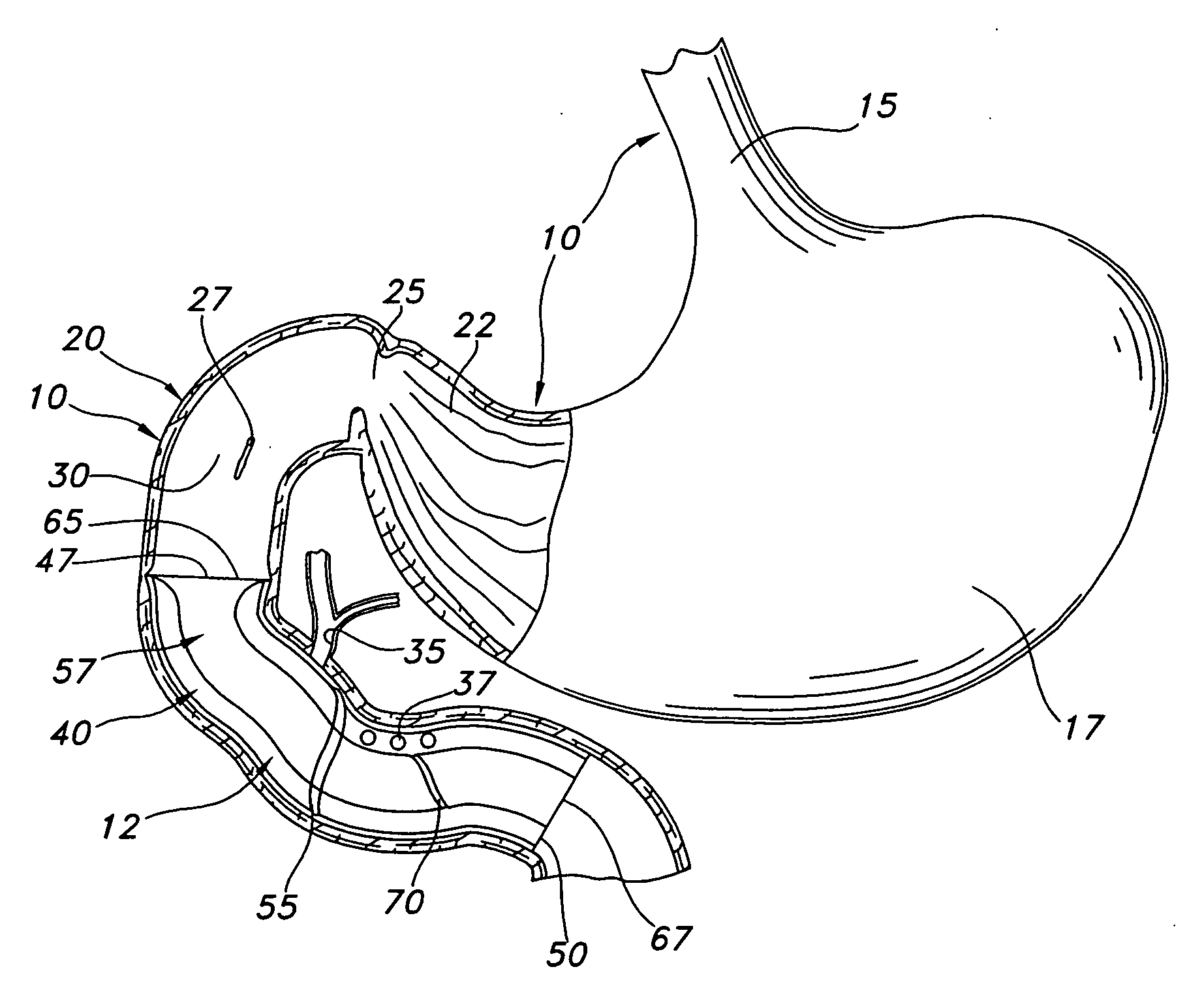 Anti-obesity dual stent