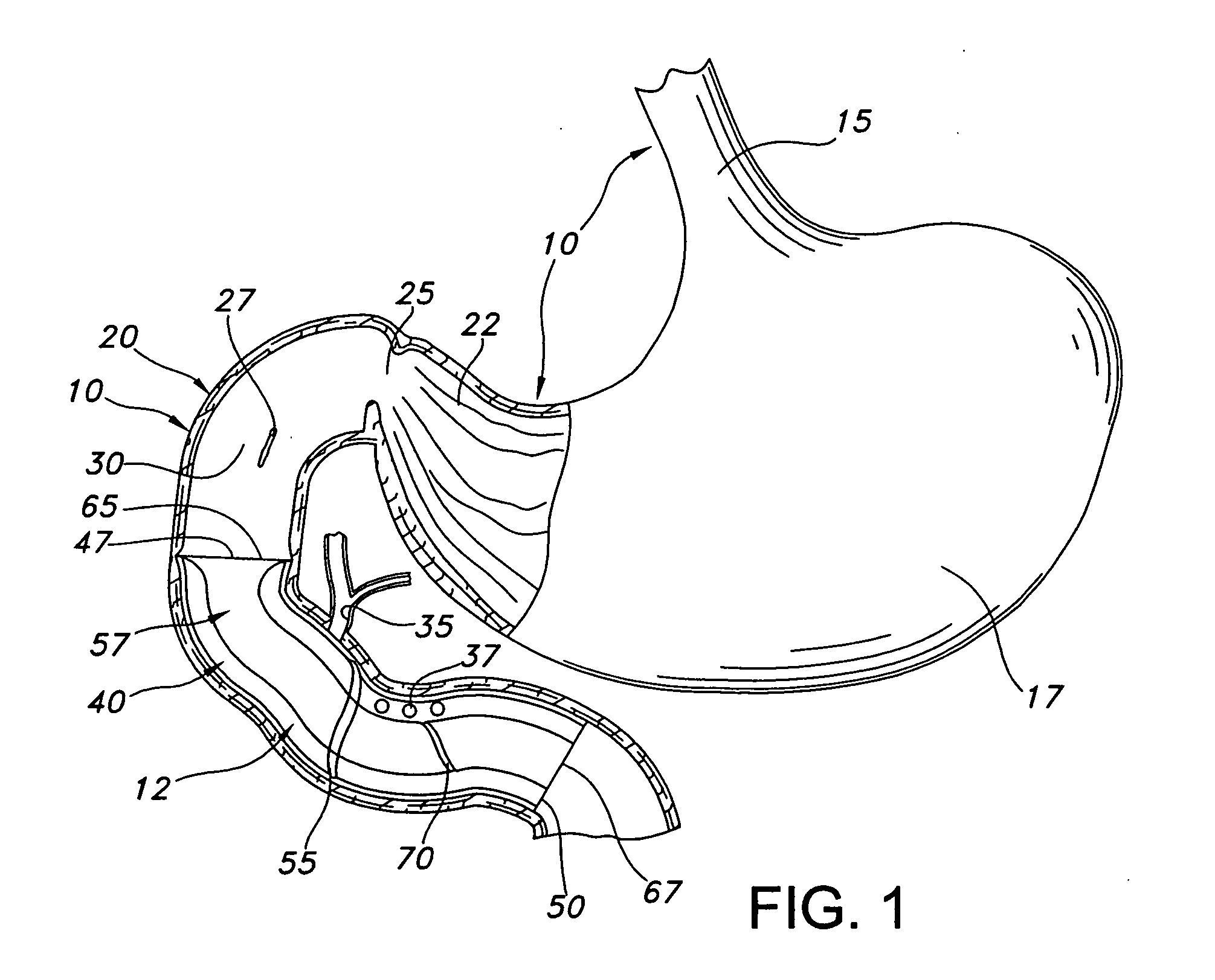 Anti-obesity dual stent