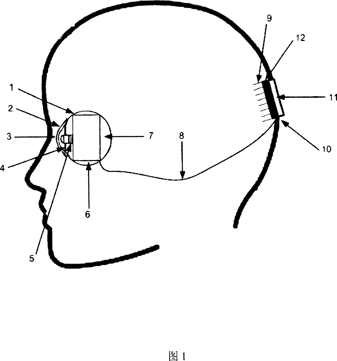 Implantable vision prosthesis