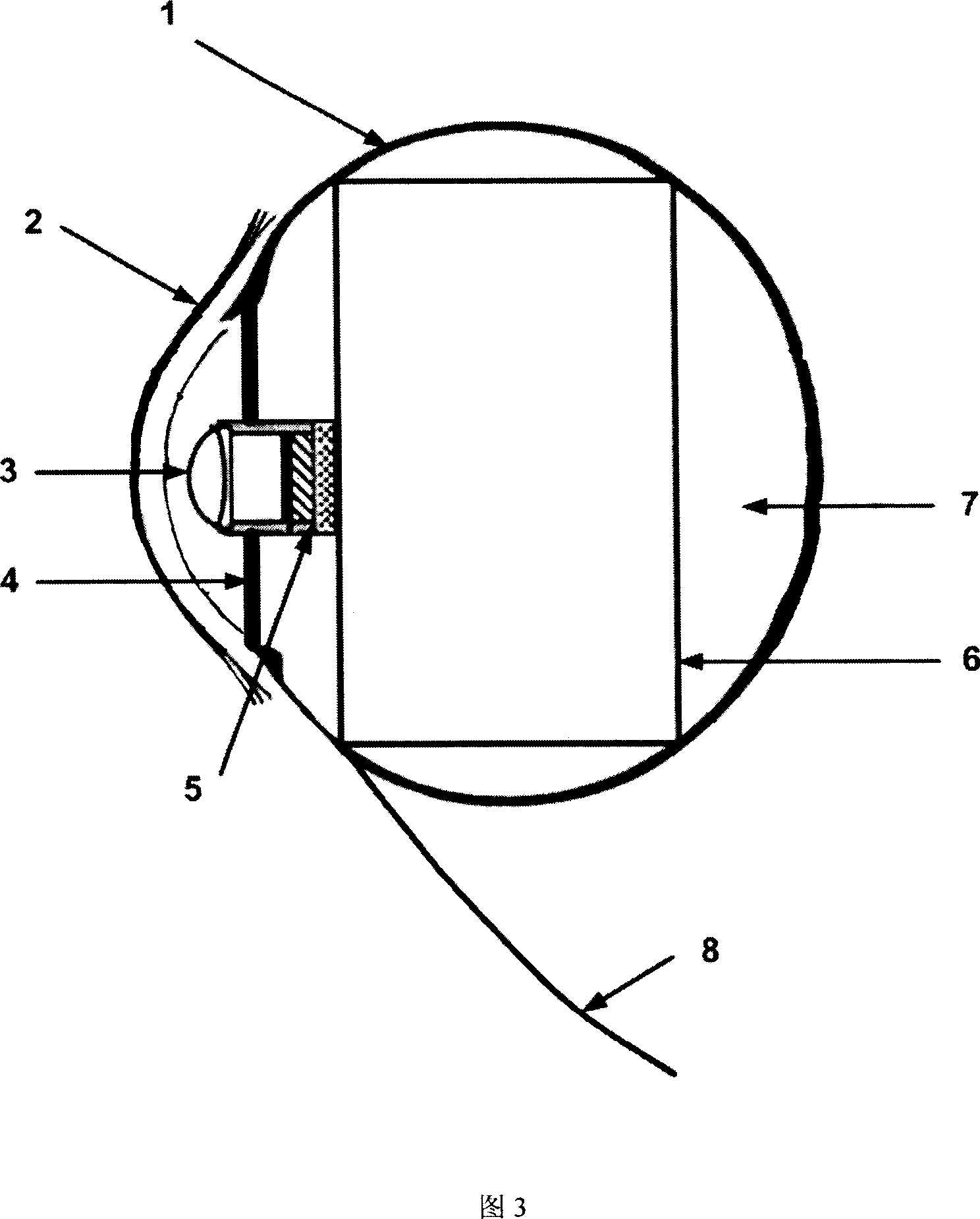 Implantable vision prosthesis