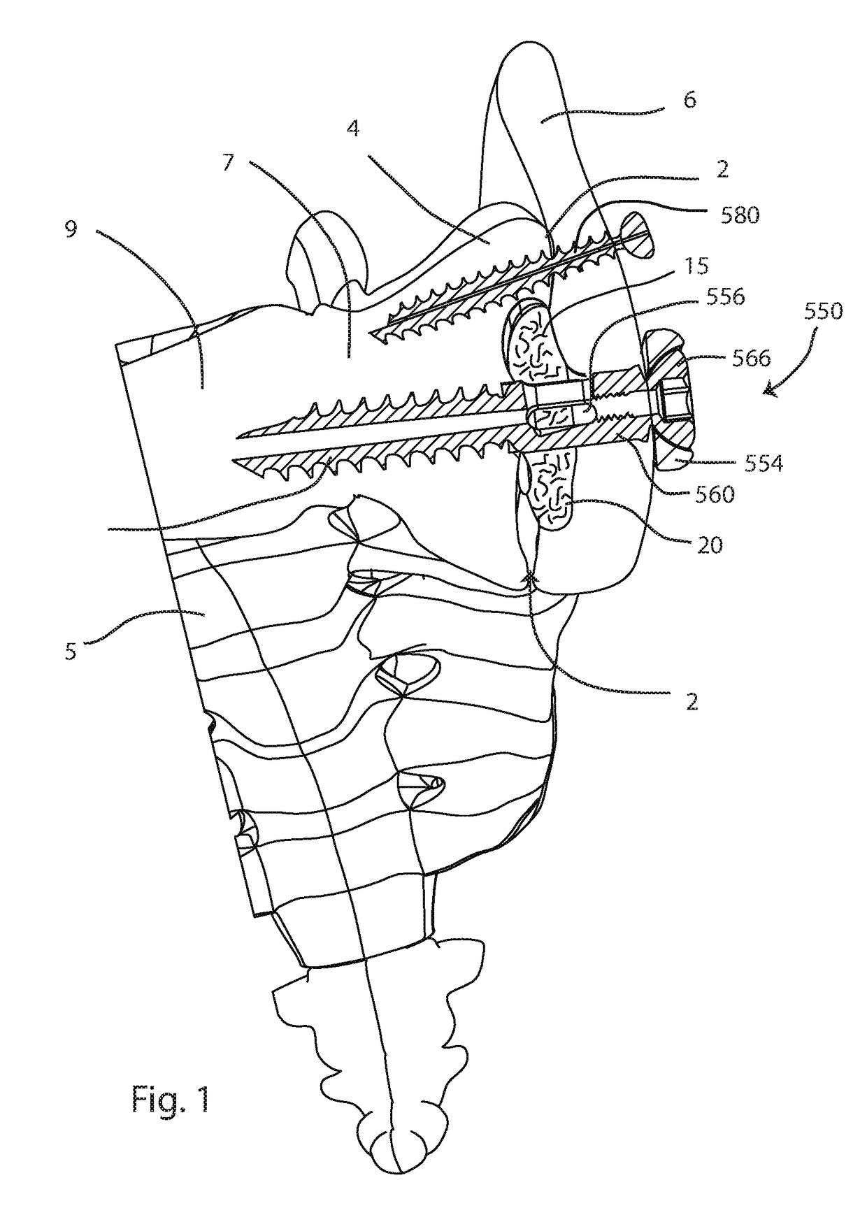 Joint fusion instrumentation and methods