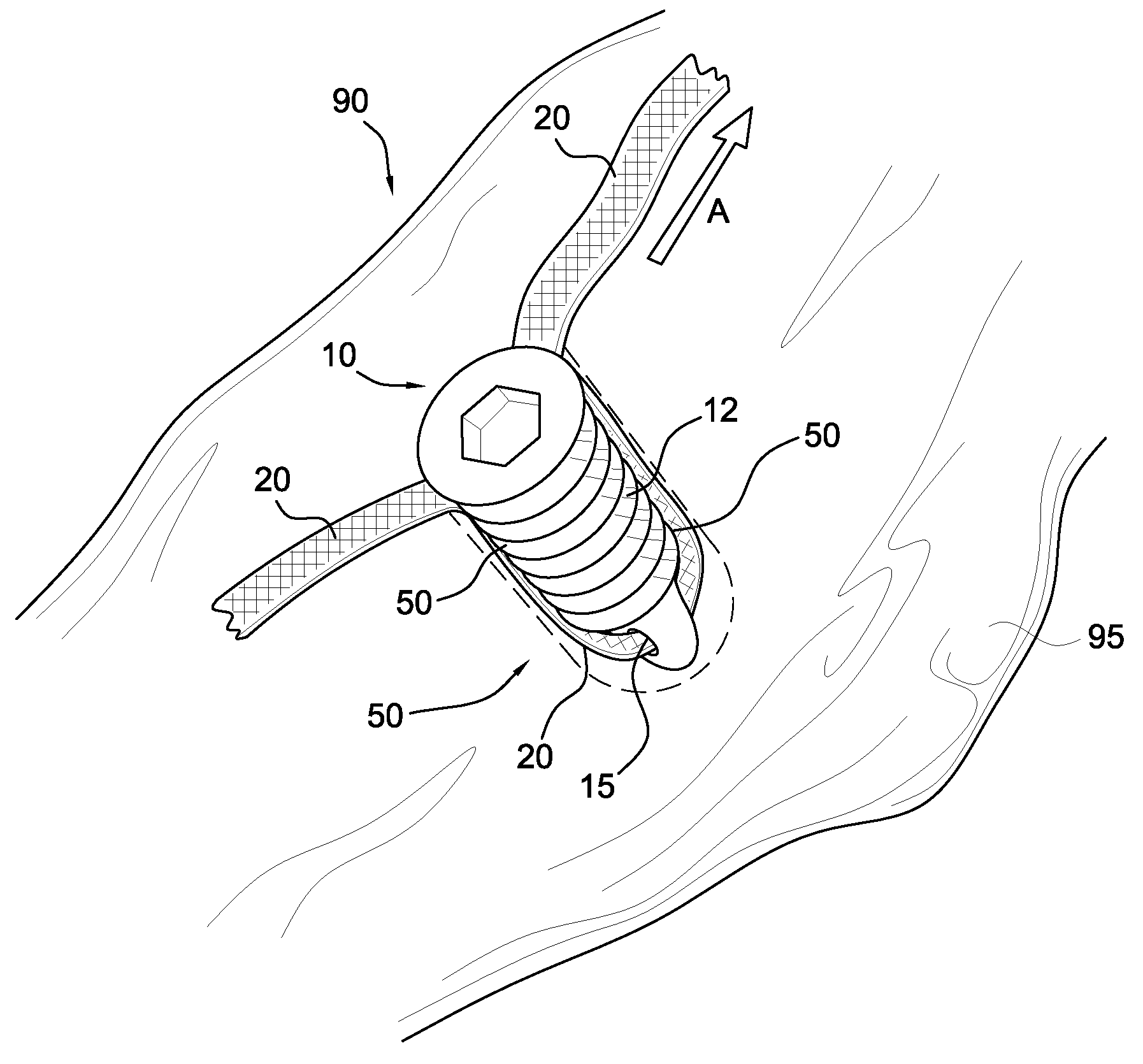 Bio-active construct created between fixation device and suture fixed in bone