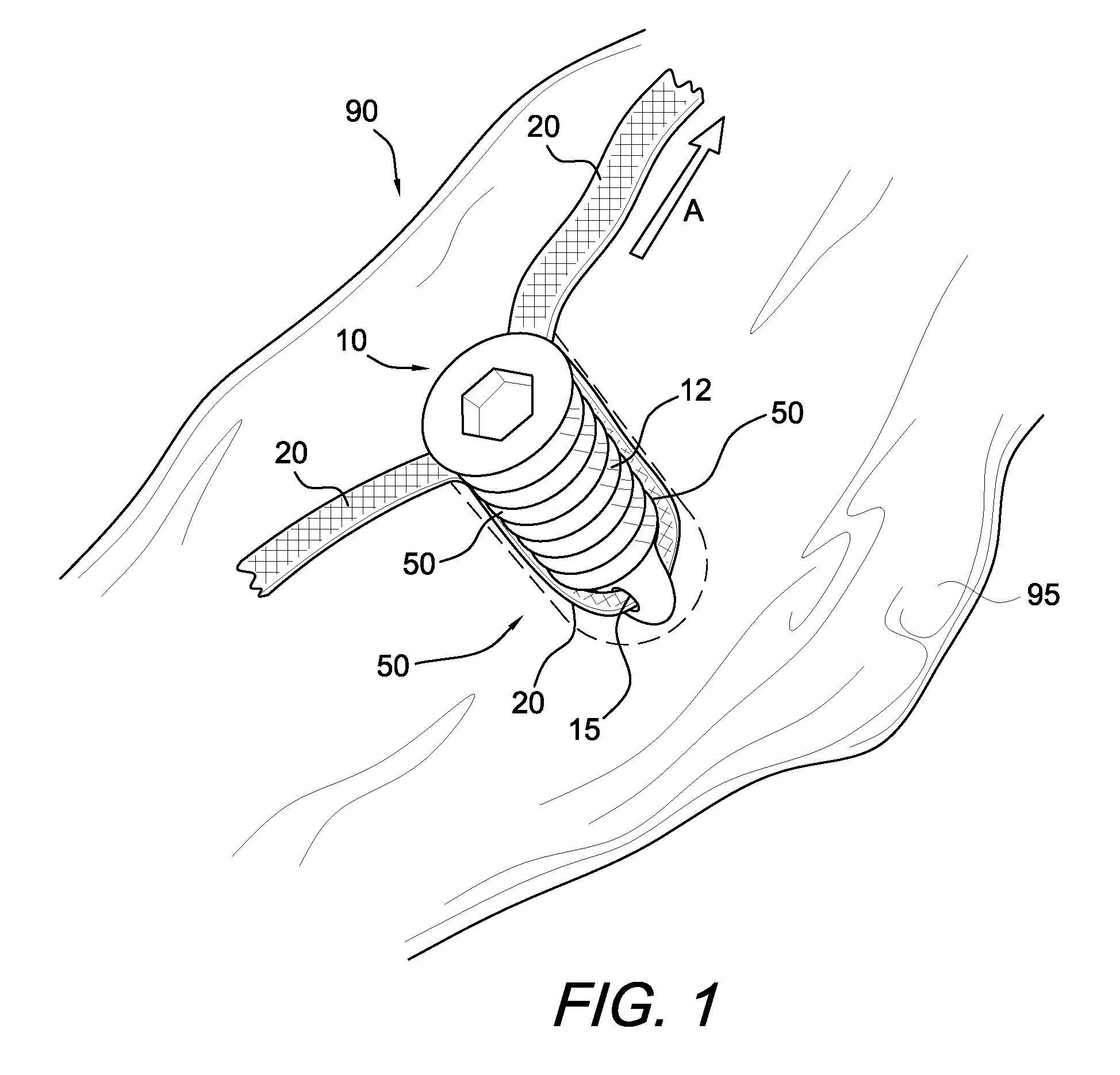 Bio-active construct created between fixation device and suture fixed in bone