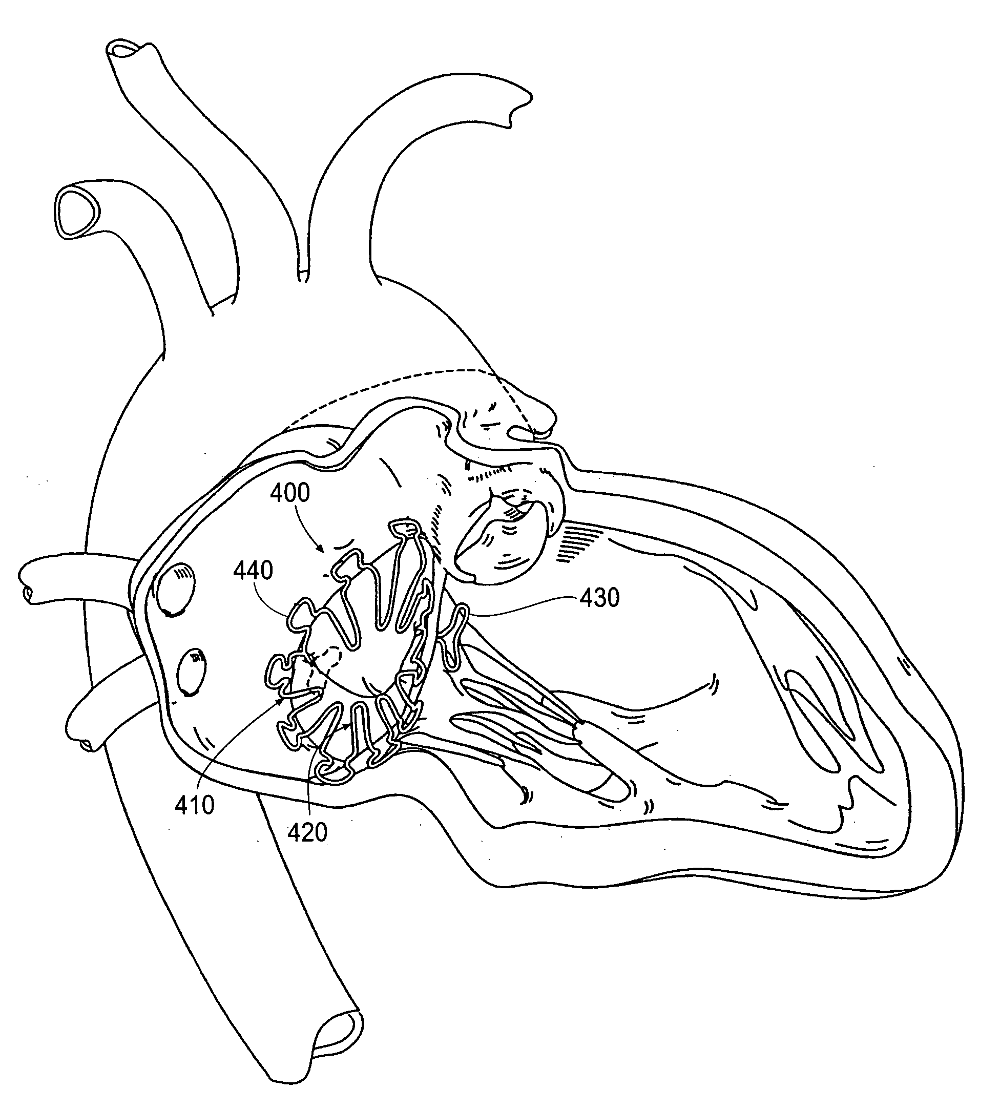 Devices, systems, and methods for retaining a native heart valve leaflet