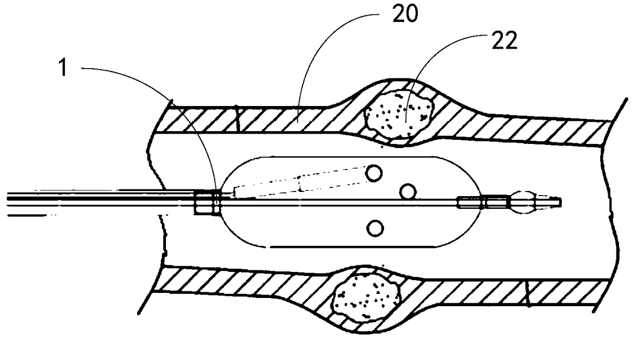 Apparatus for treating cardiac valve and vascular calcification and method of using the same