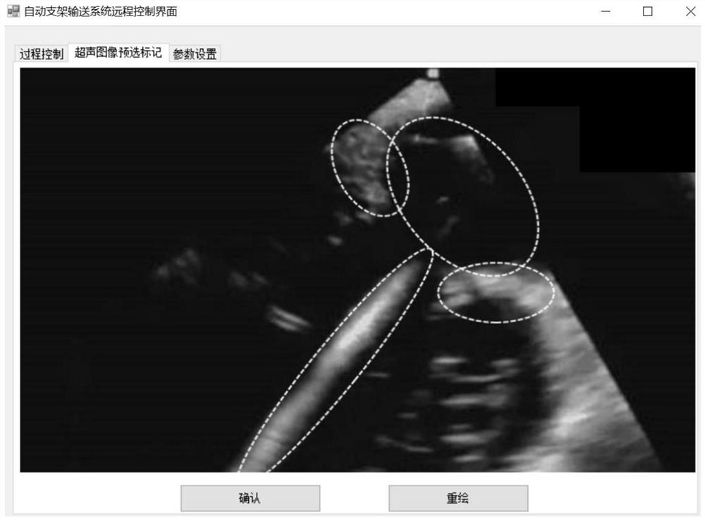 Automatic valve stent conveying system based on image segmentation