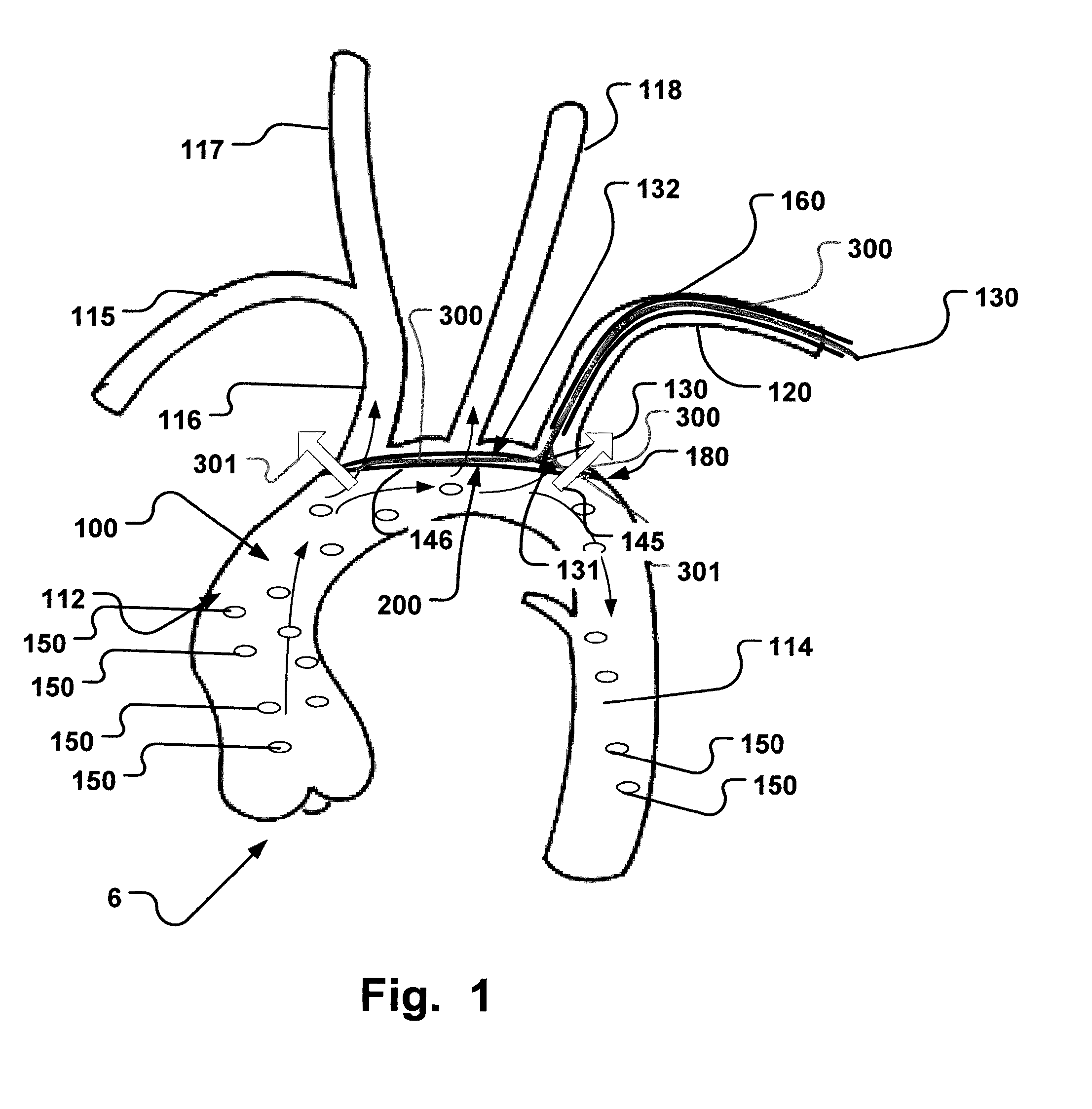 Improved Embolic Protection Device And Method