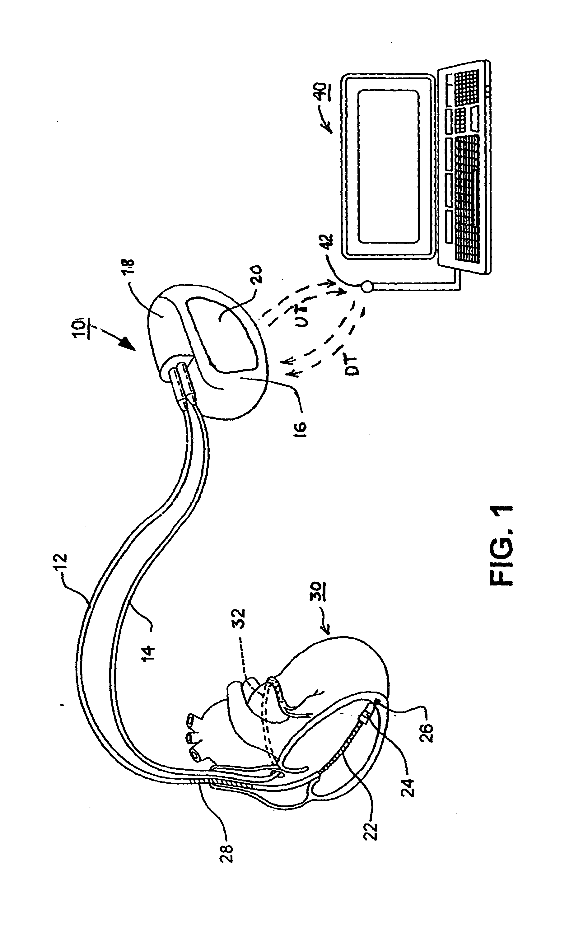 Methods and apparatus for discriminating polymorphic tachyarrhythmias from monomorphic tachyarrhythmias facilitating detection of fibrillation