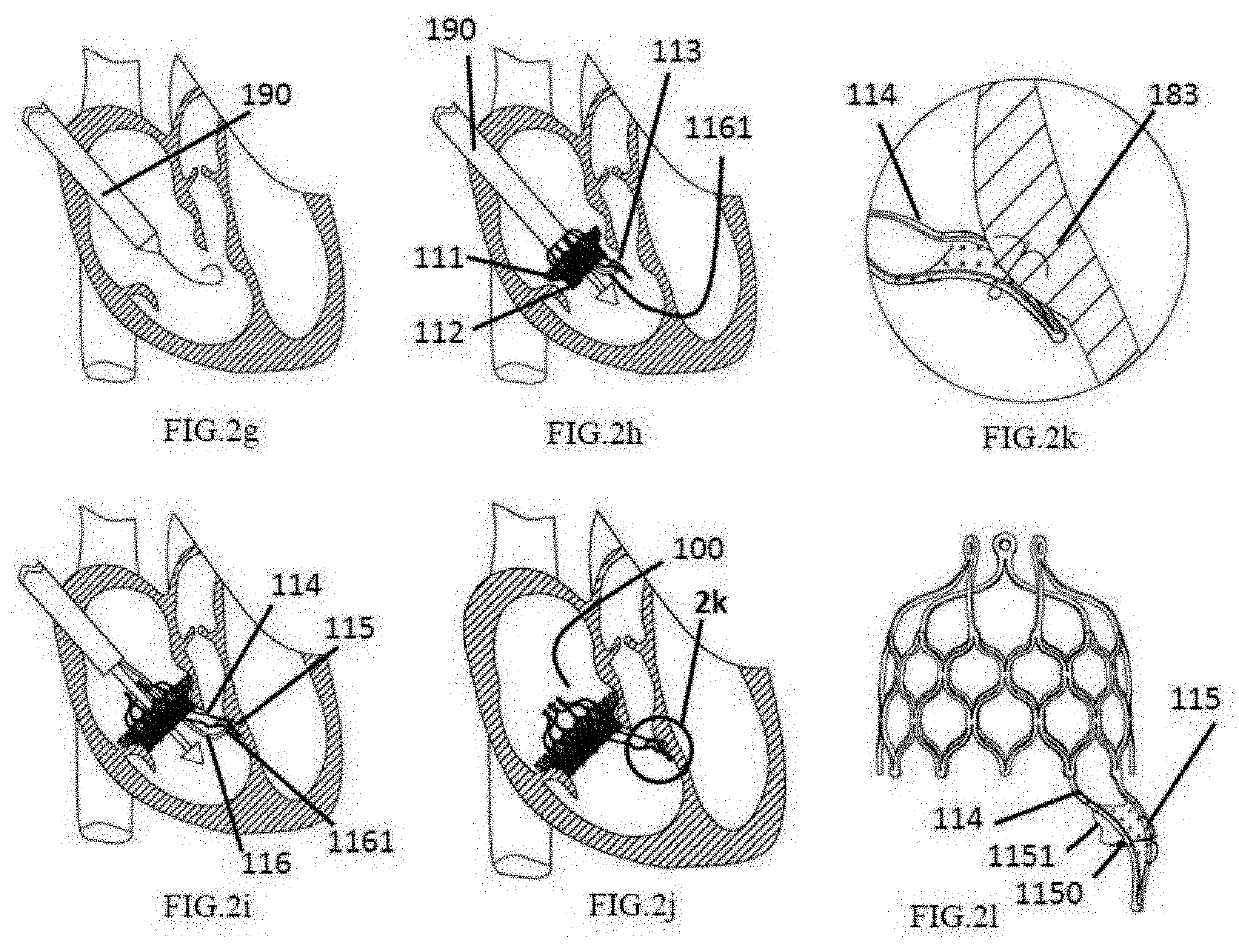 Heart valve prosthesis anchored to interventricular septum and conveying and releasing method thereof