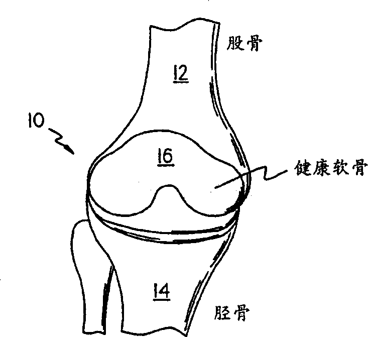 Methods instruments and materials for chondrocyte cell transplantation