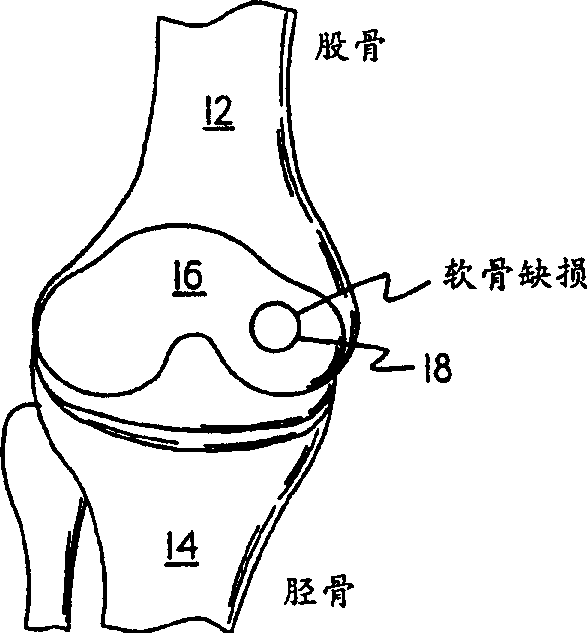 Methods instruments and materials for chondrocyte cell transplantation