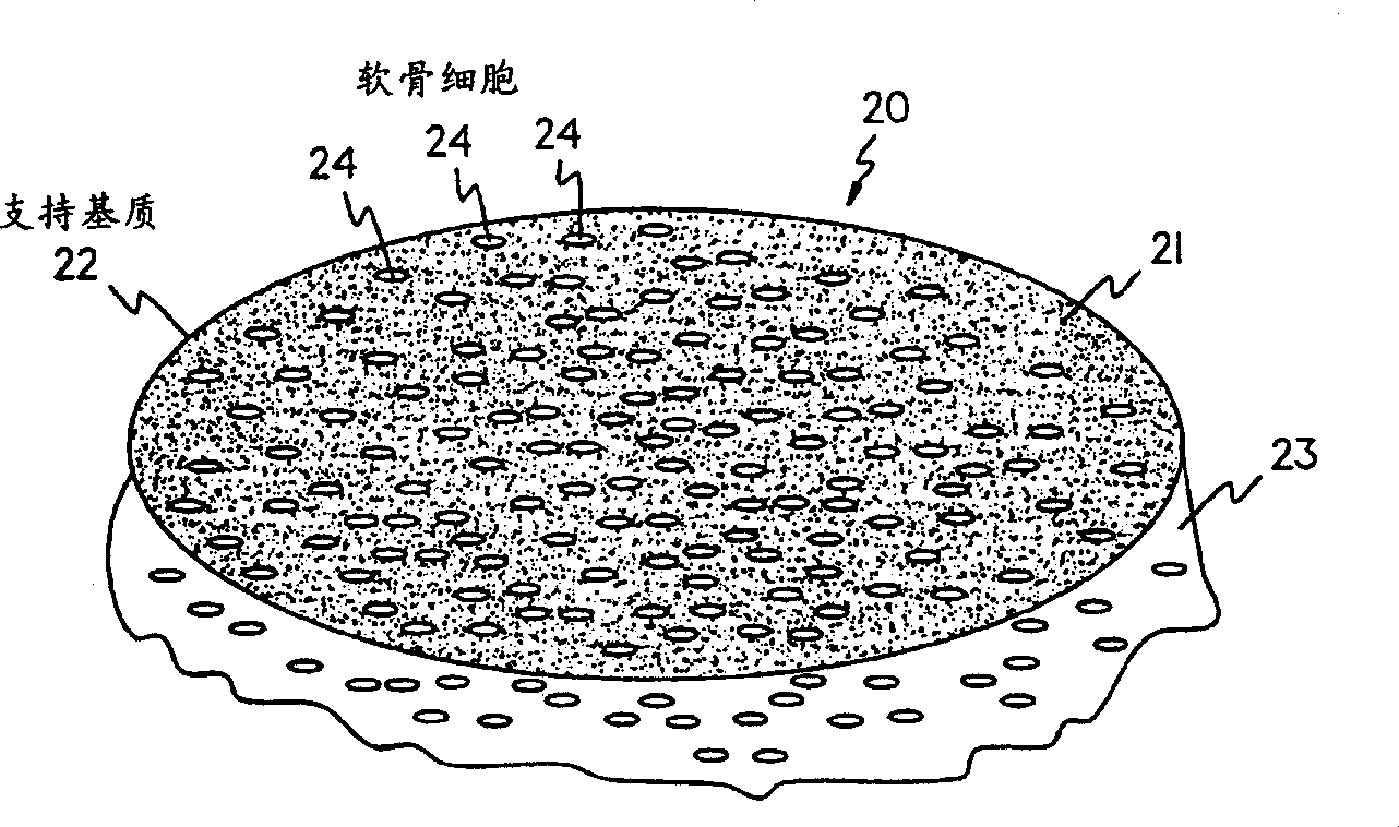 Methods instruments and materials for chondrocyte cell transplantation