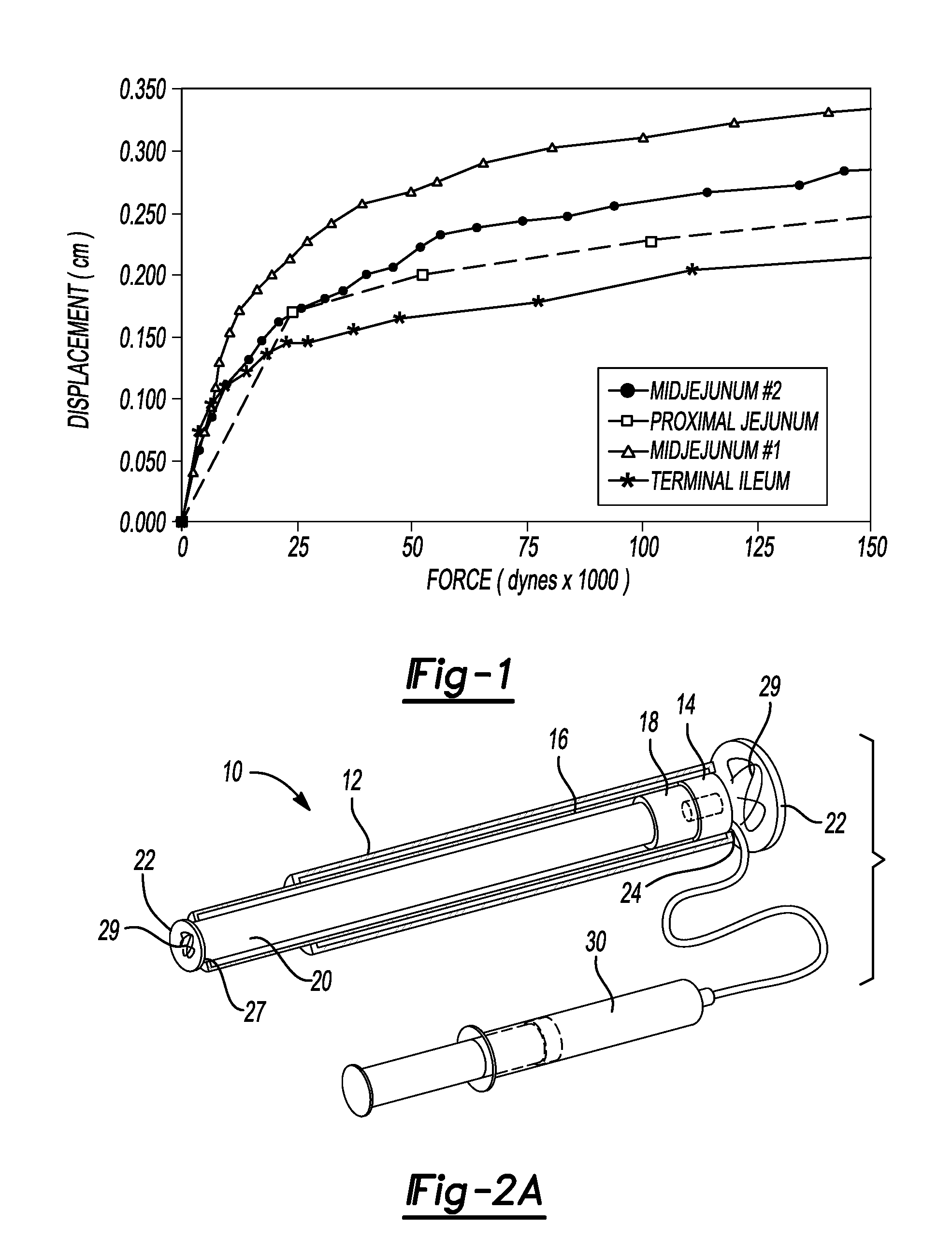 Mechanical extension implants for short bowel syndrome