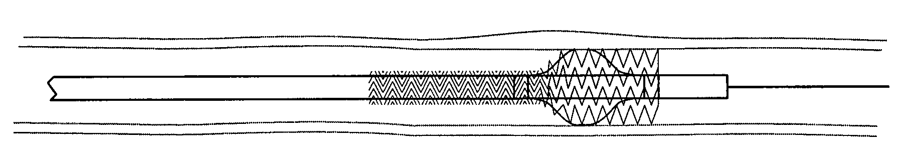 Conformable vascular prosthesis delivery system