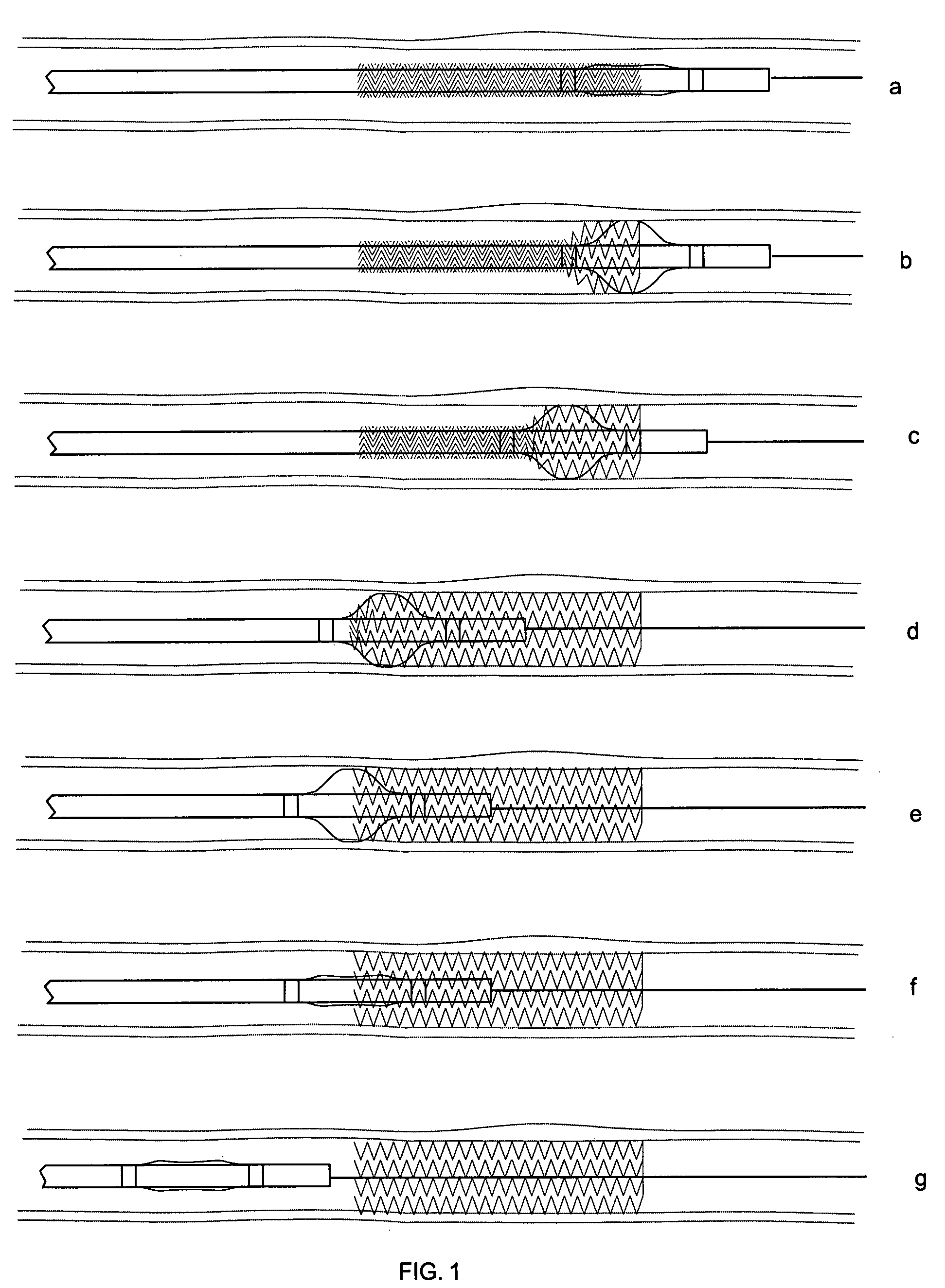 Conformable vascular prosthesis delivery system