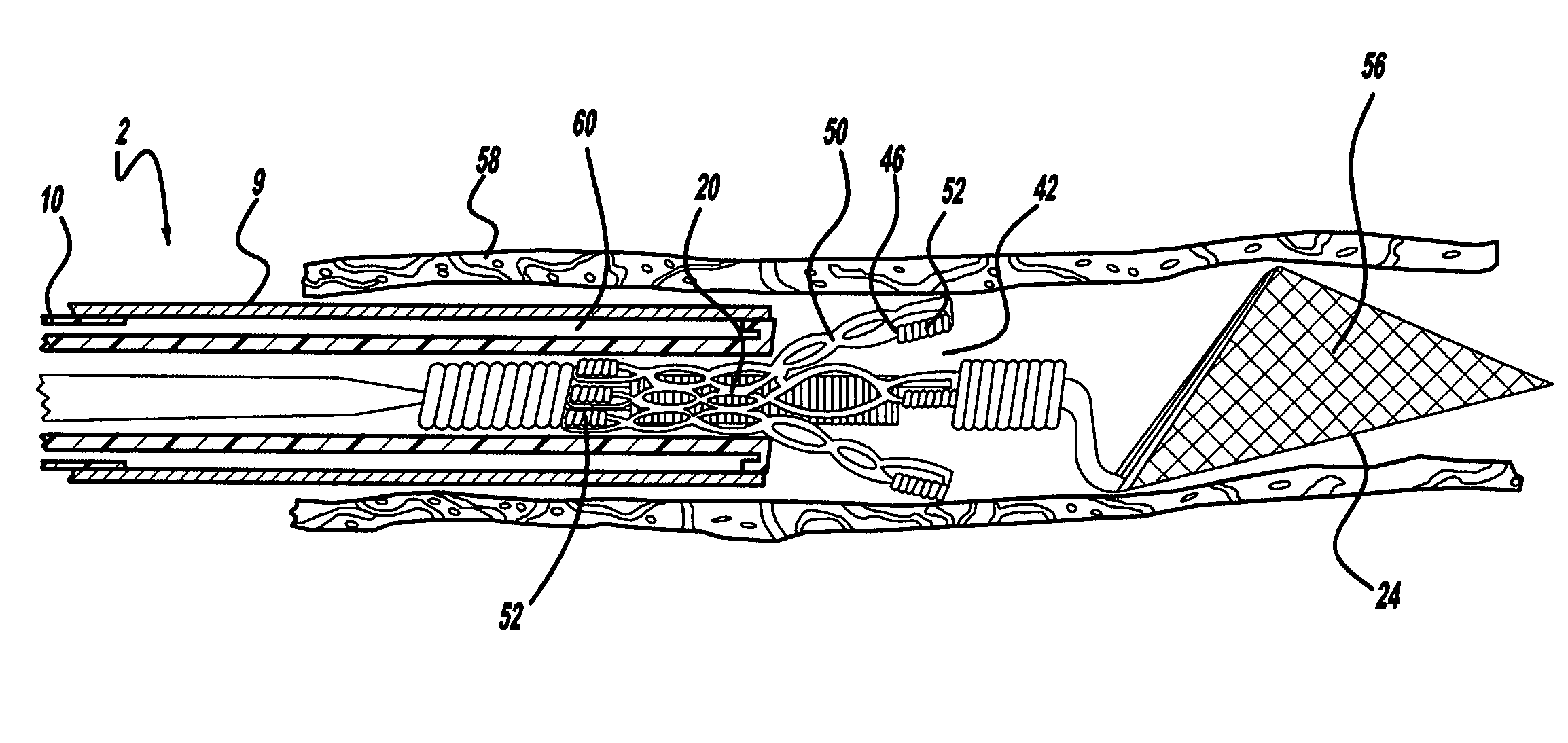 Self-expanding stent and stent delivery system with distal protection