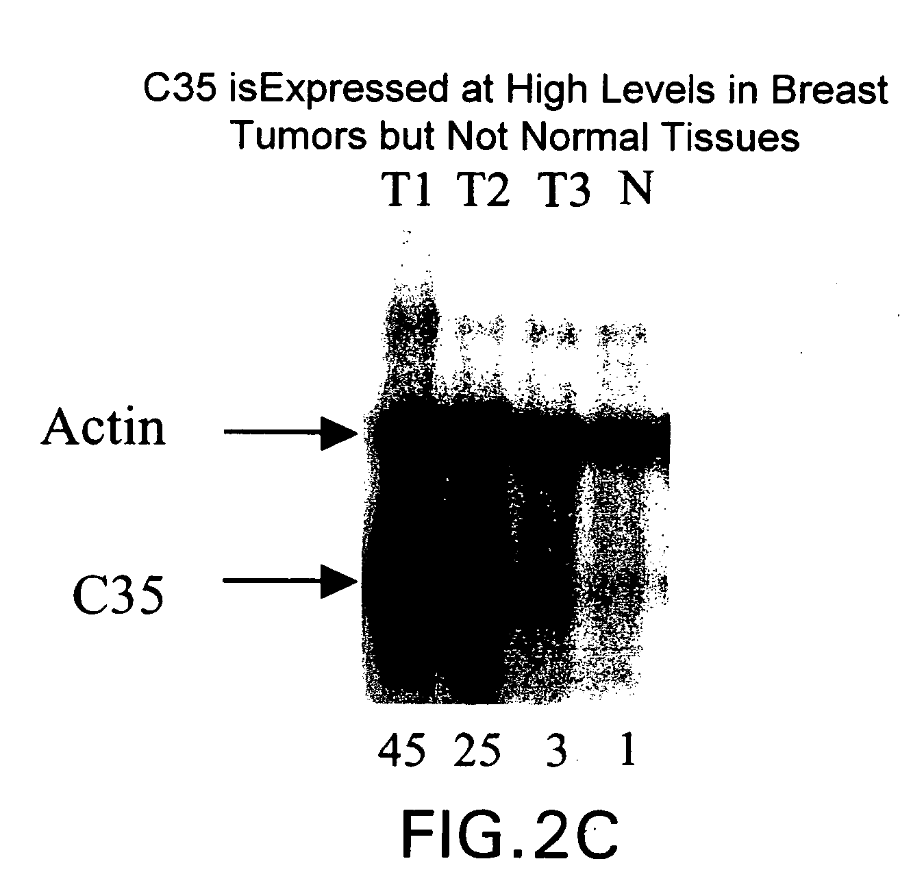 Gene differentially expressed in breast and bladder cancer, and encoded polypeptides