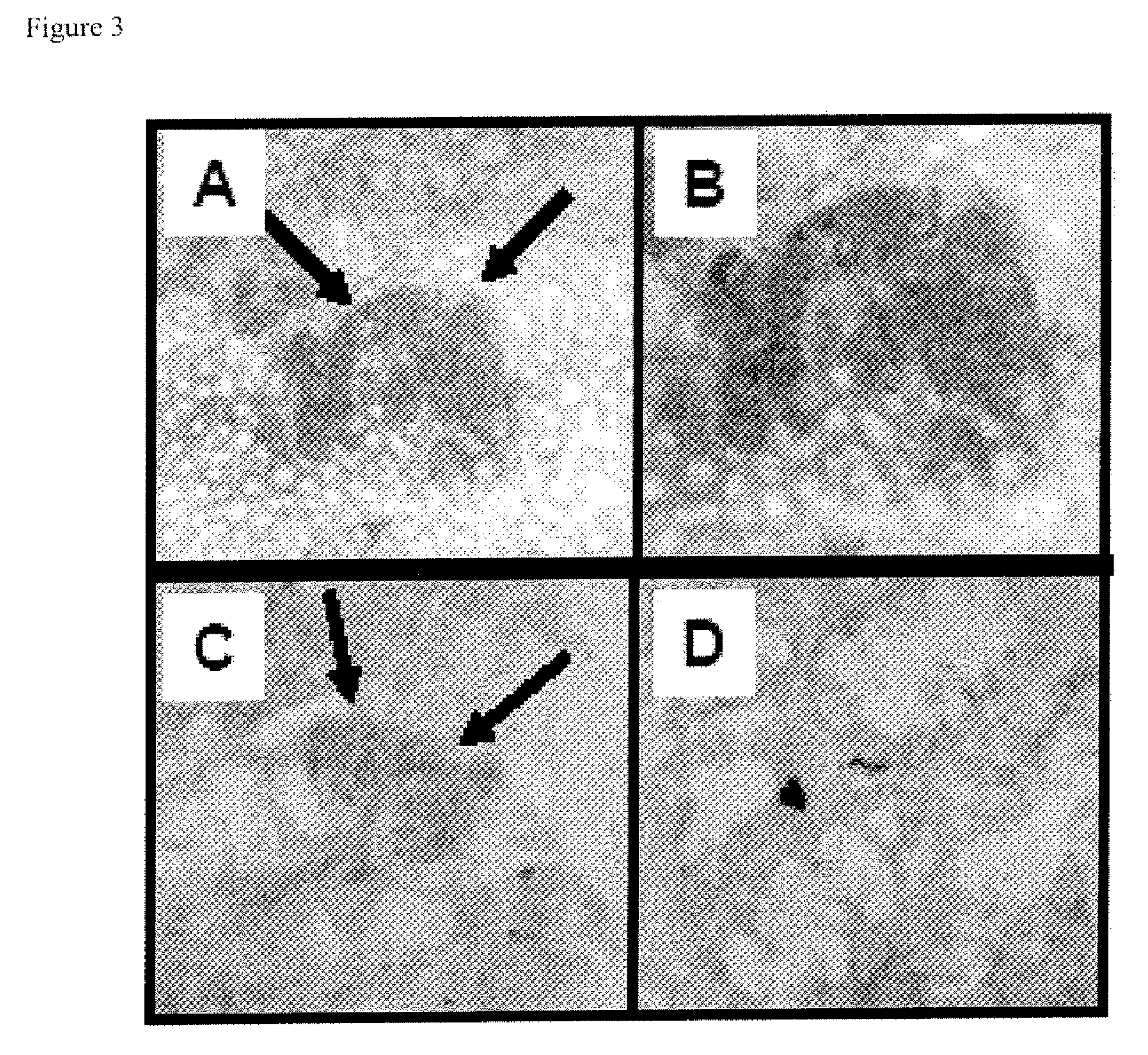 Treatment of cancer with Anti-muscarinic receptor agents