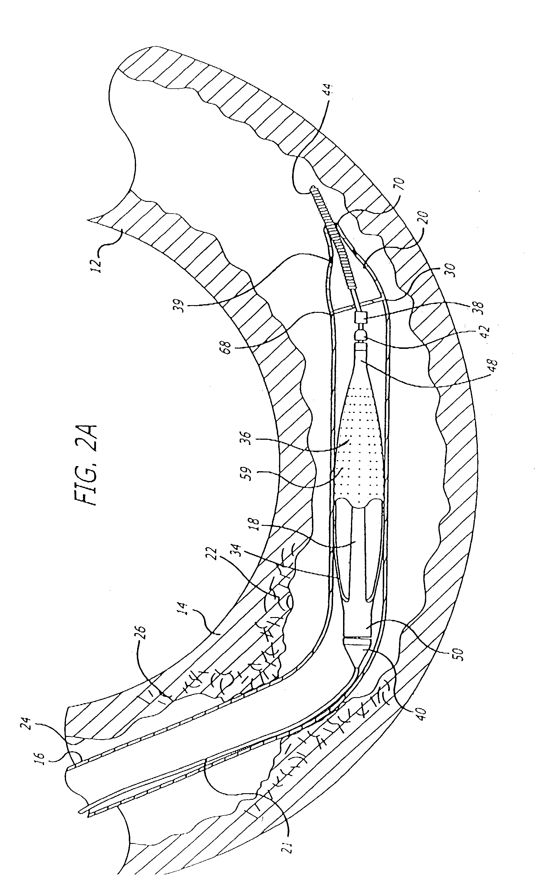 Hinged short cage for an embolic protection device