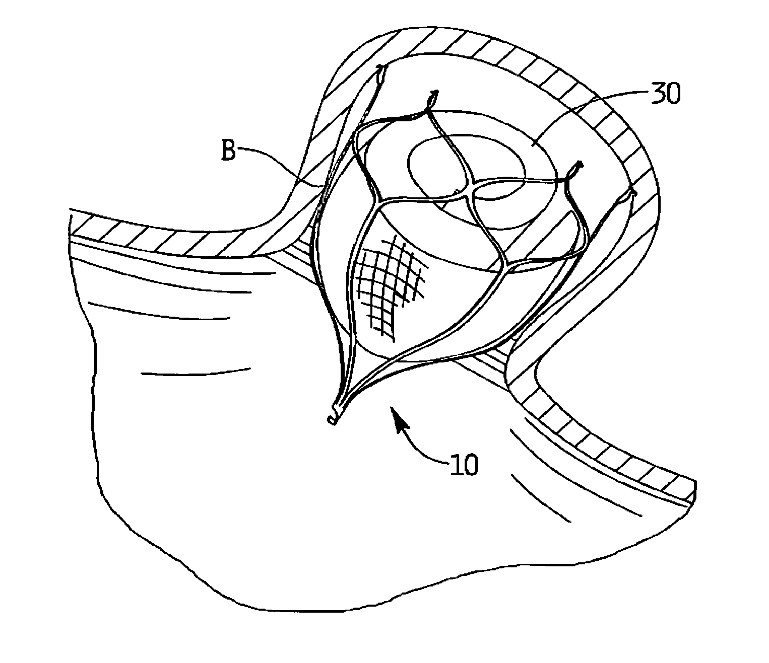 Device for preventing clot migraton from left atrial appendage