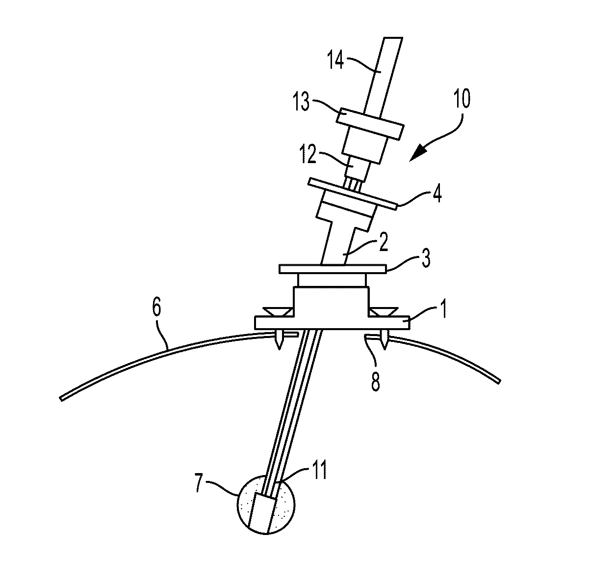 System and method for intracranial implantation of therapeutic or diagnostic agents