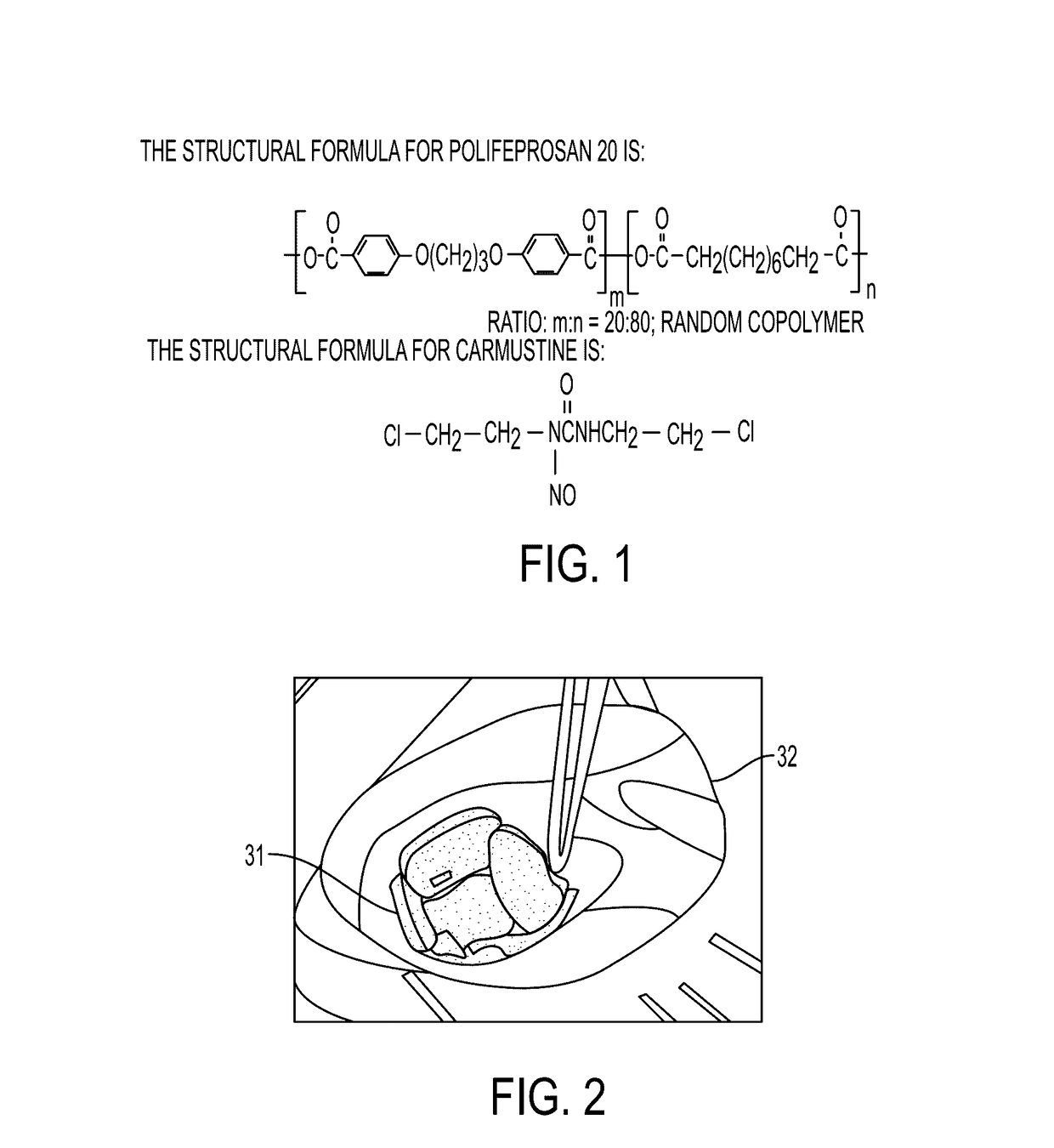 System and method for intracranial implantation of therapeutic or diagnostic agents