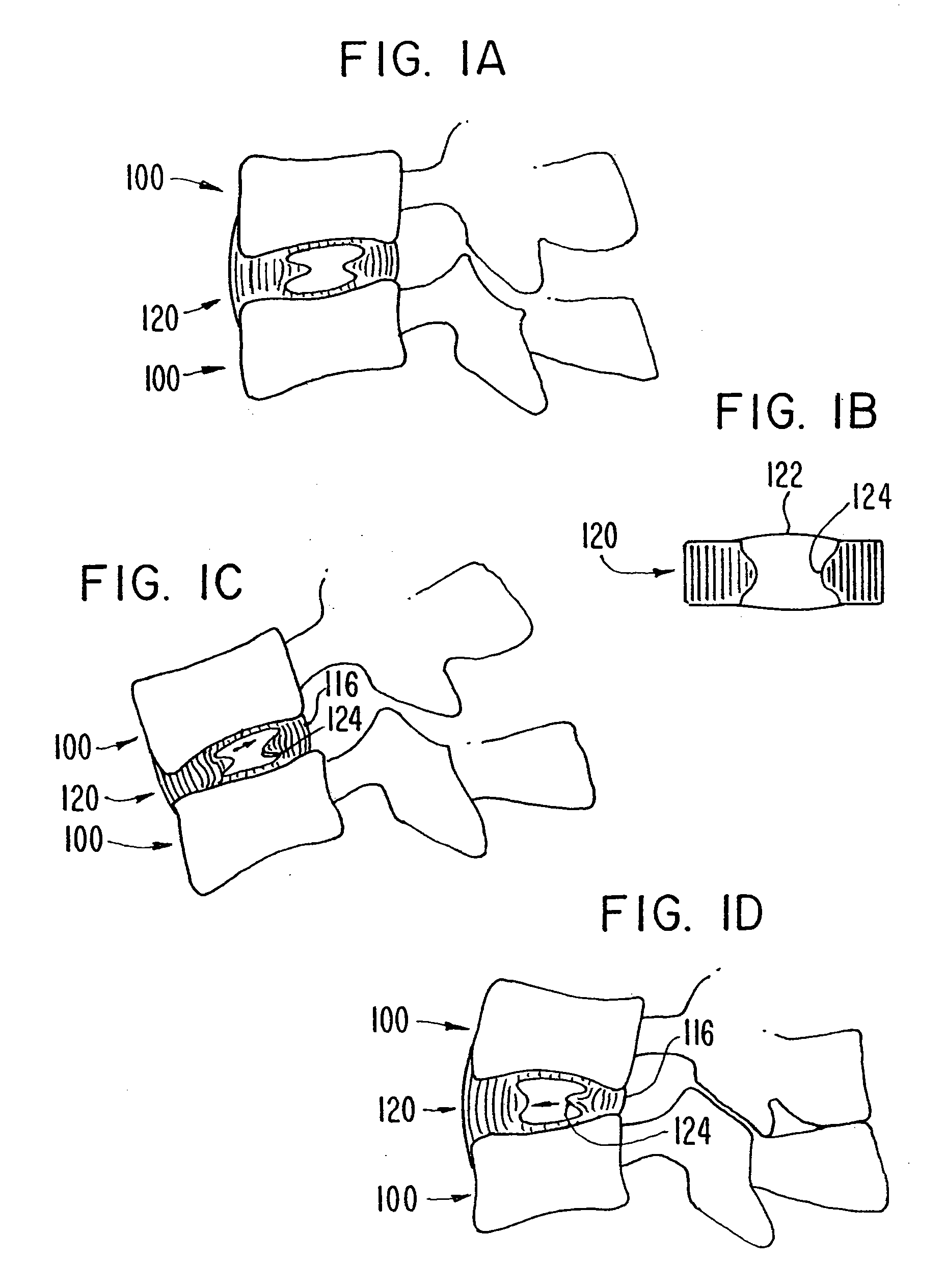 Intervertebral disc and nucleus prosthesis