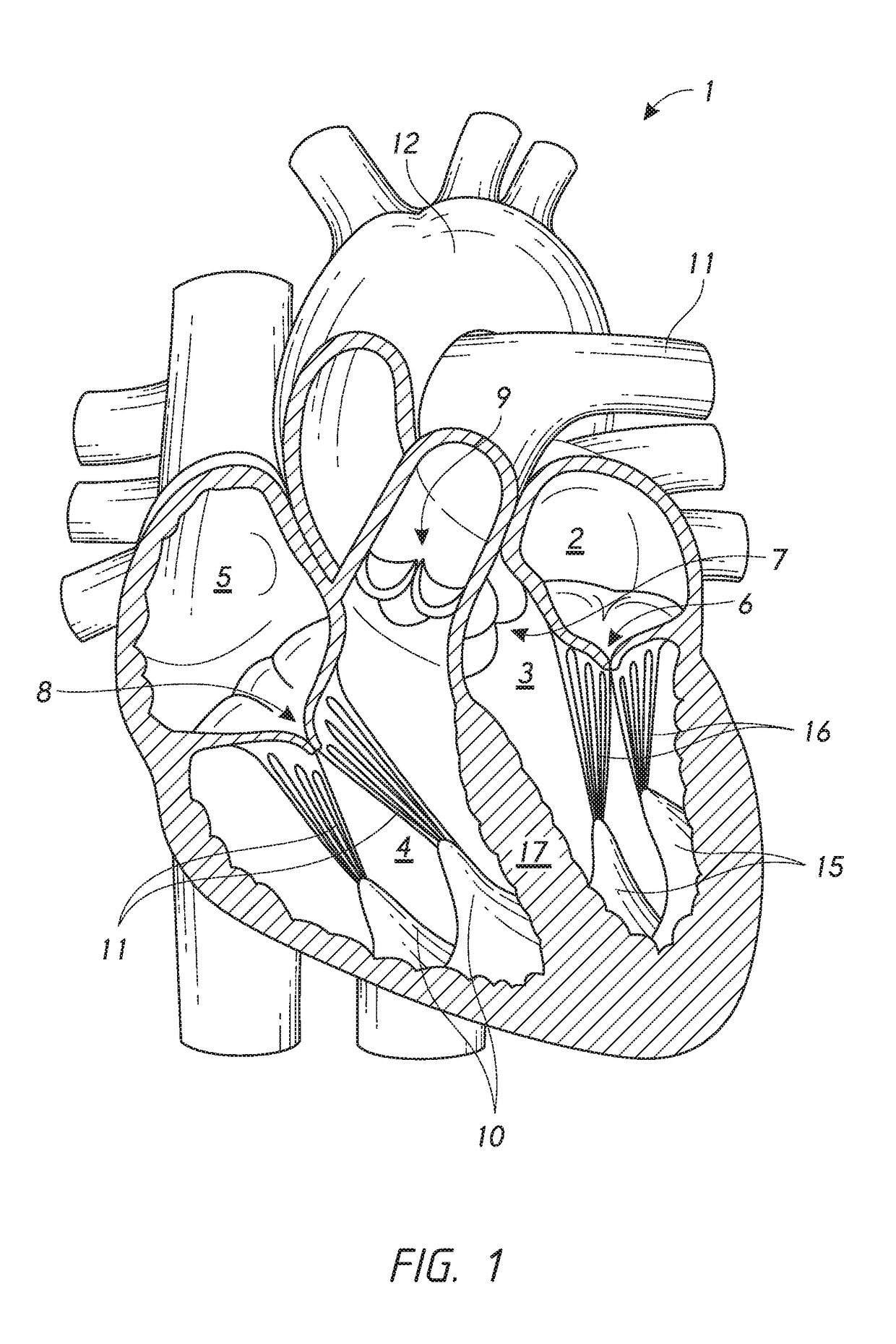 Chordae tendineae adjustment