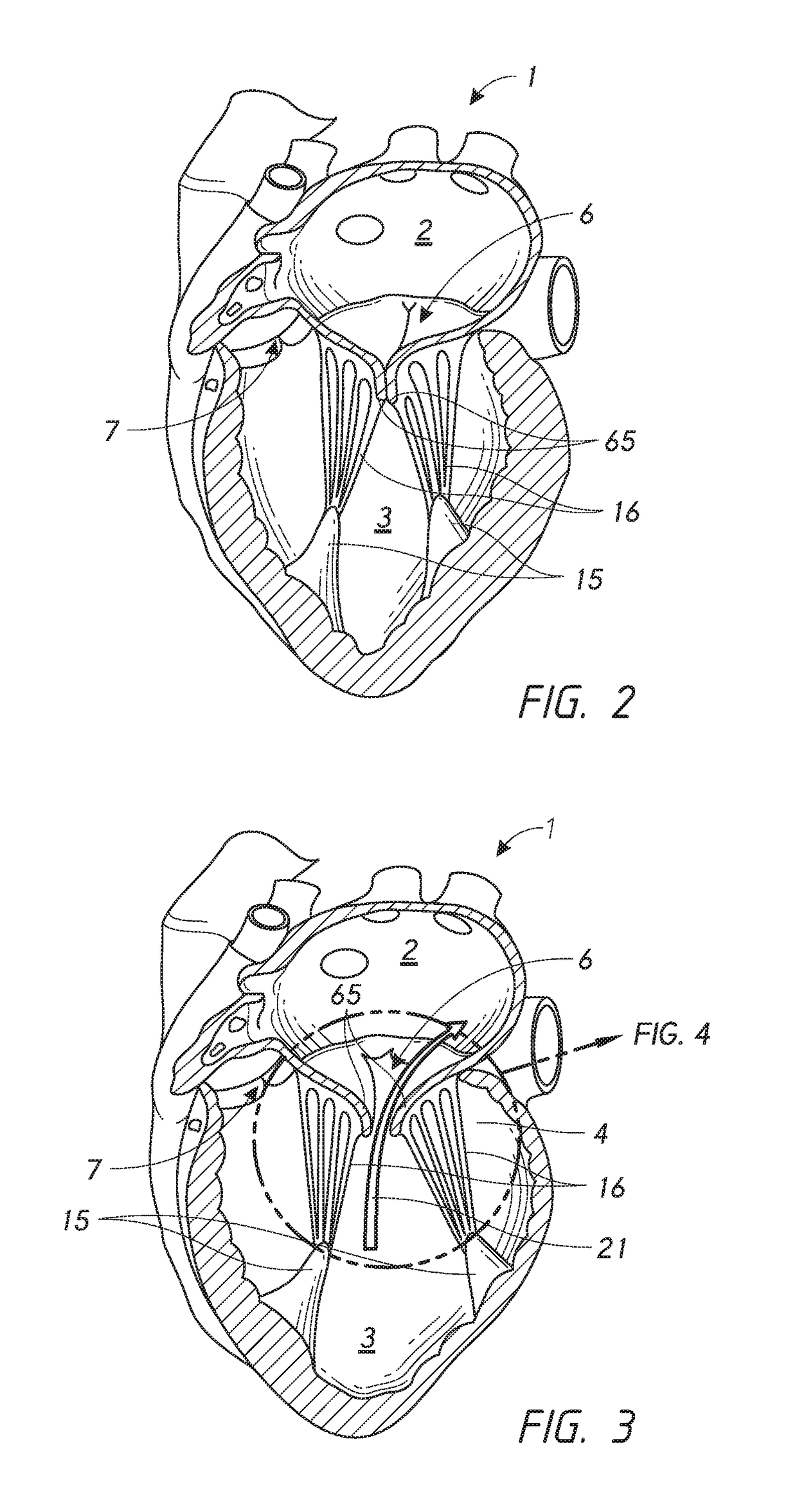 Chordae tendineae adjustment