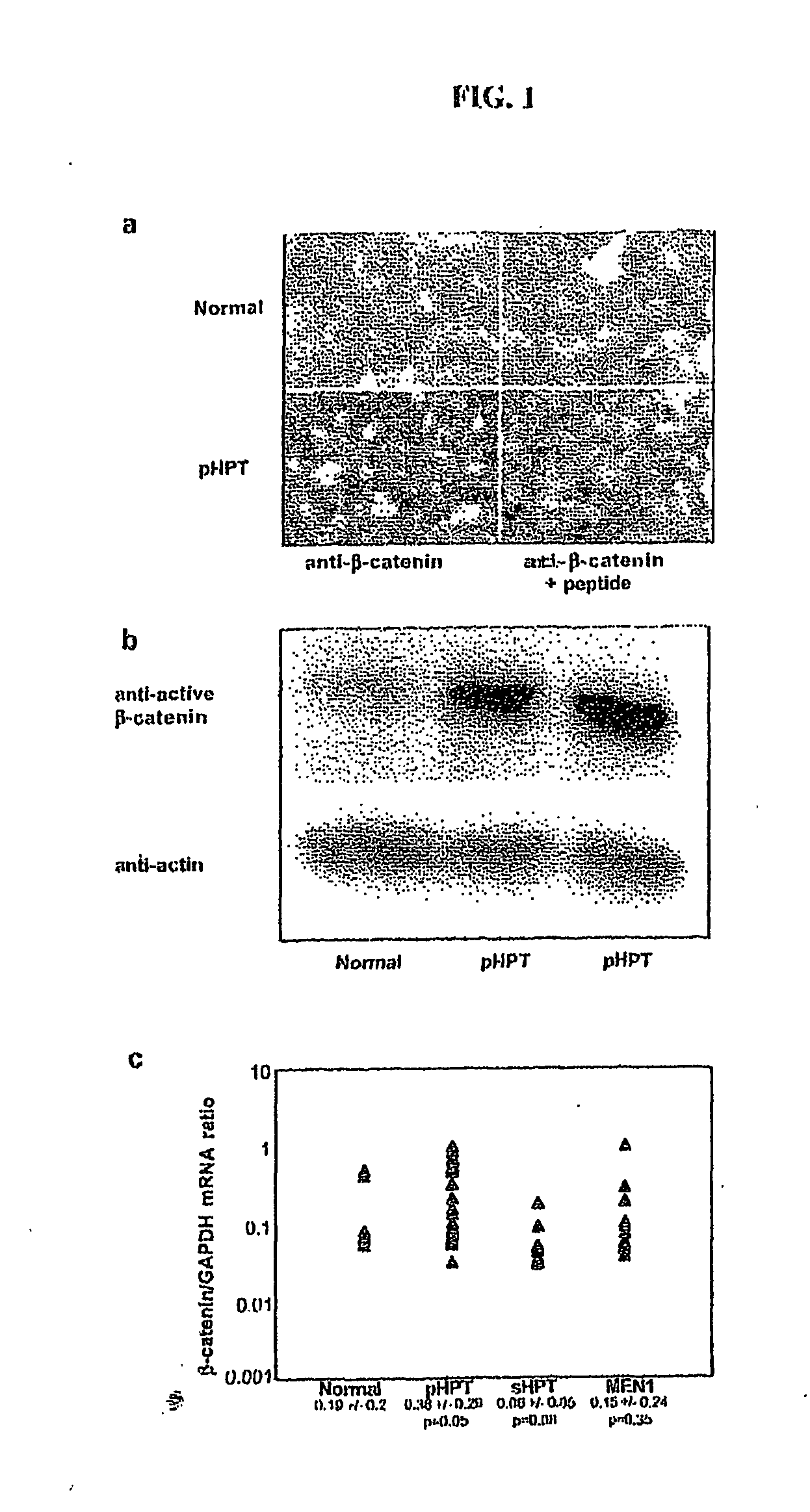 Mutant Lrp5/6 Wnt-Signaling Receptors in Cancer Diagnosis, Prognosis, and Treatment