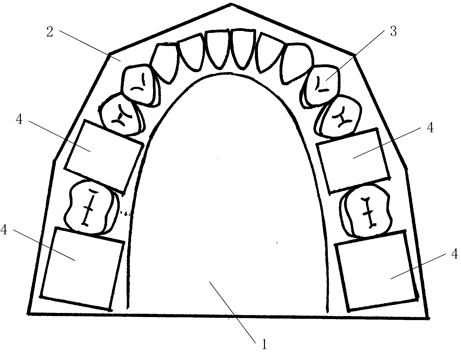 Complex tooth extraction model