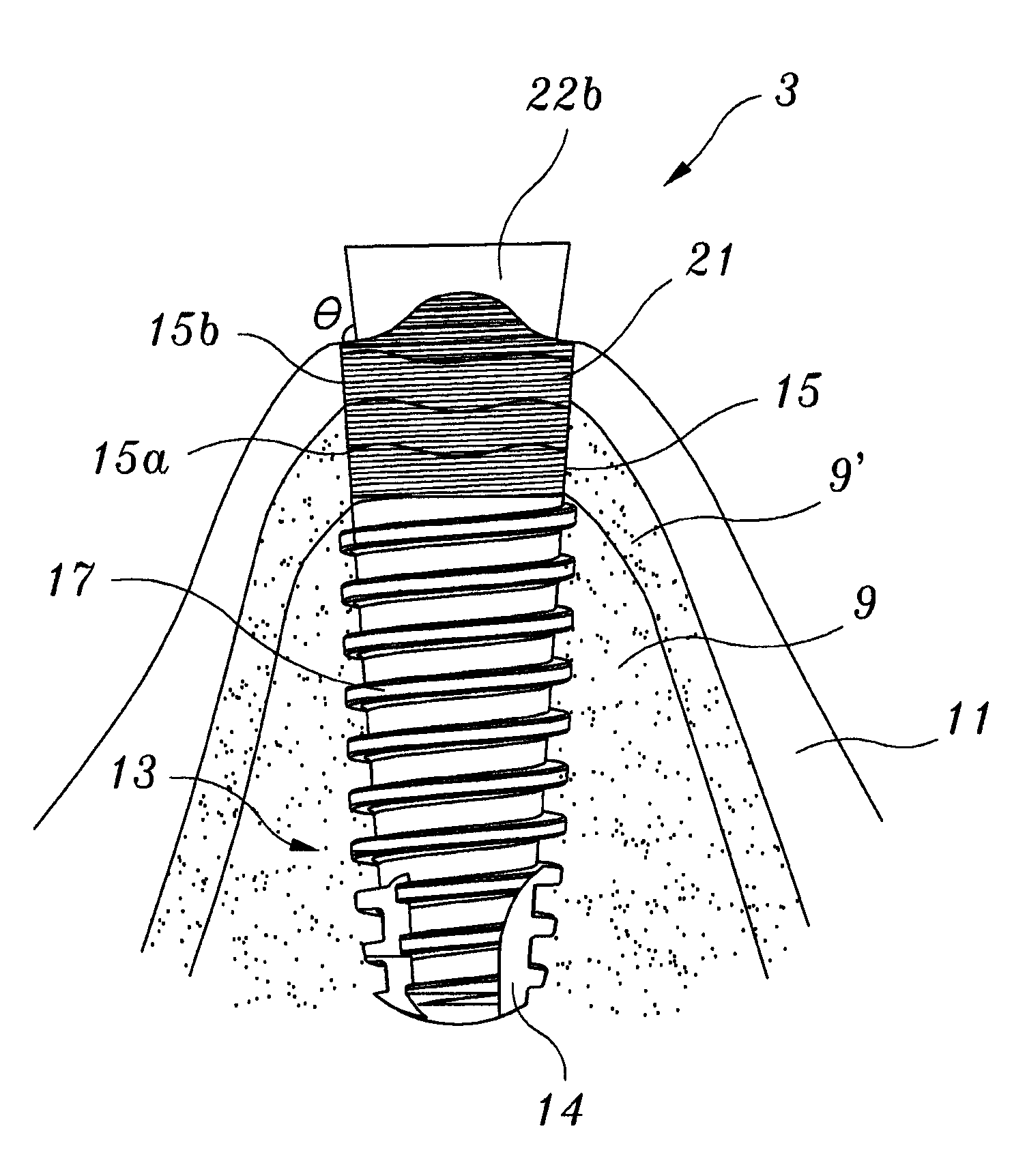 Waved implant integrating soft tissue area and osseous tissue area