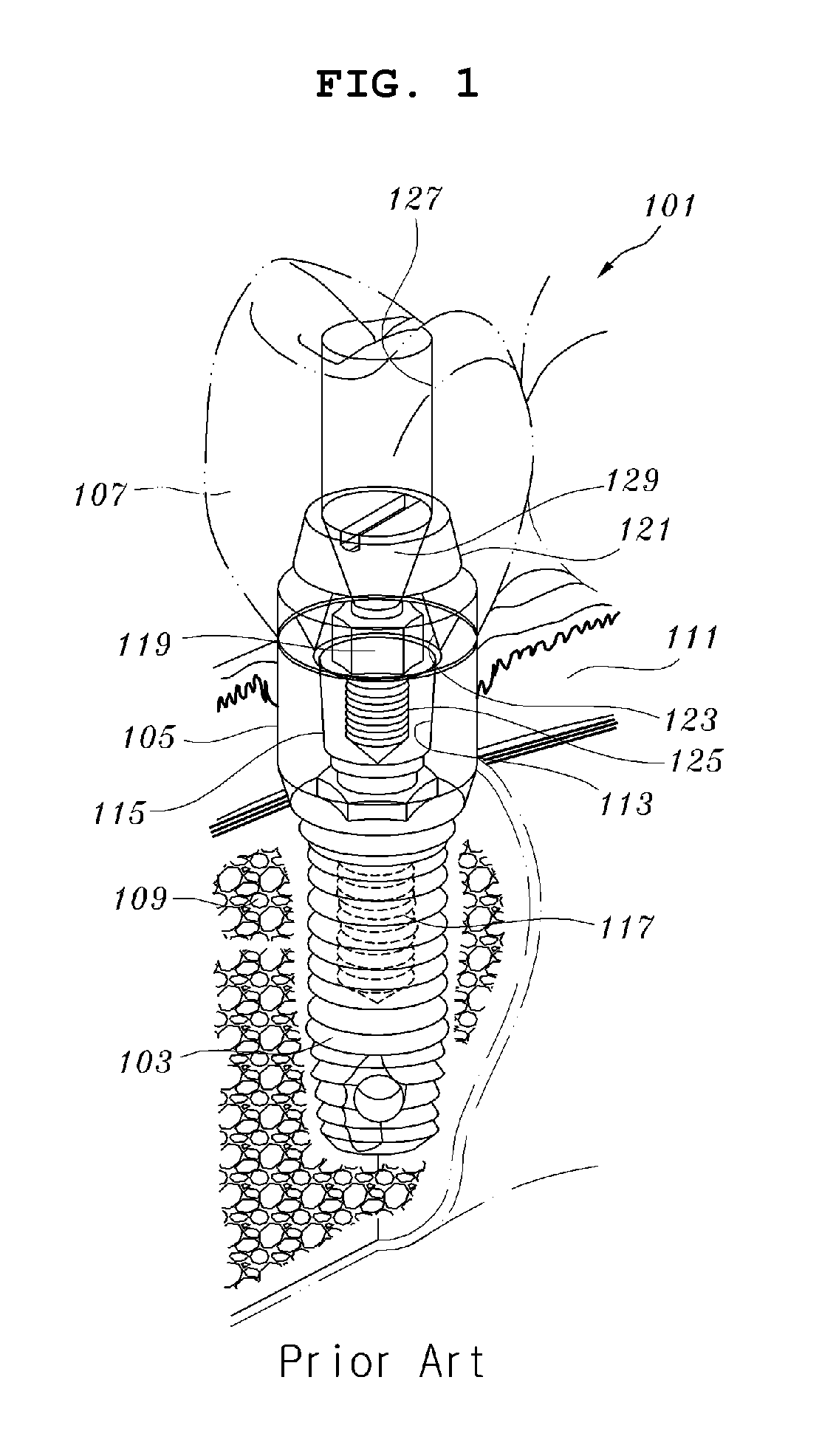 Waved implant integrating soft tissue area and osseous tissue area