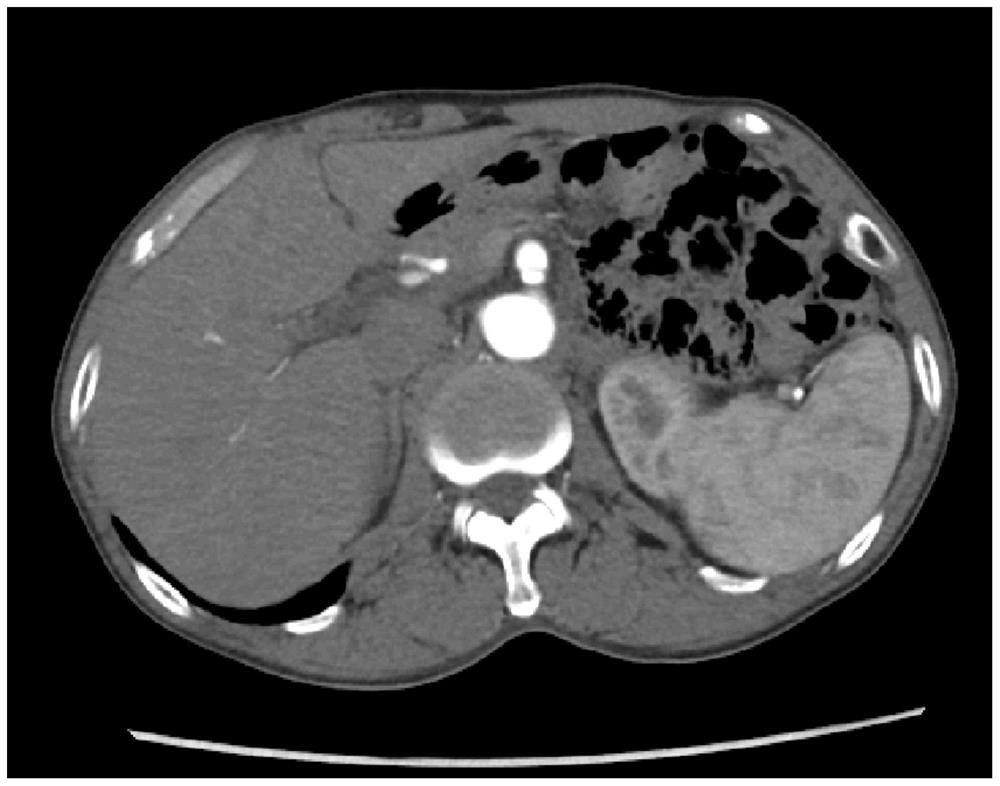 Non-invasive calculation method of ffr in superior mesenteric artery dissection based on CT images