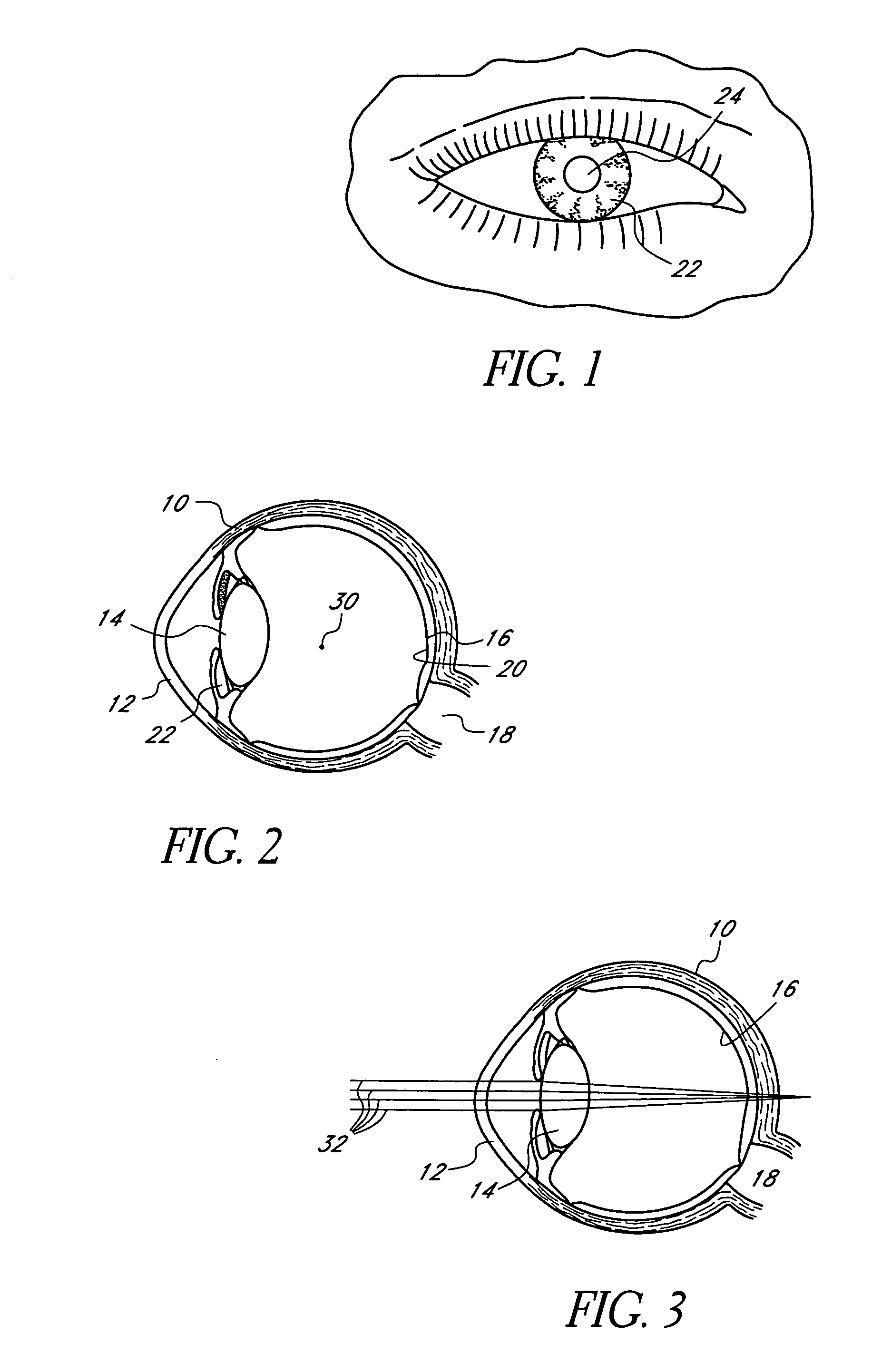 Corneal optic formed of degradation resistant polymer