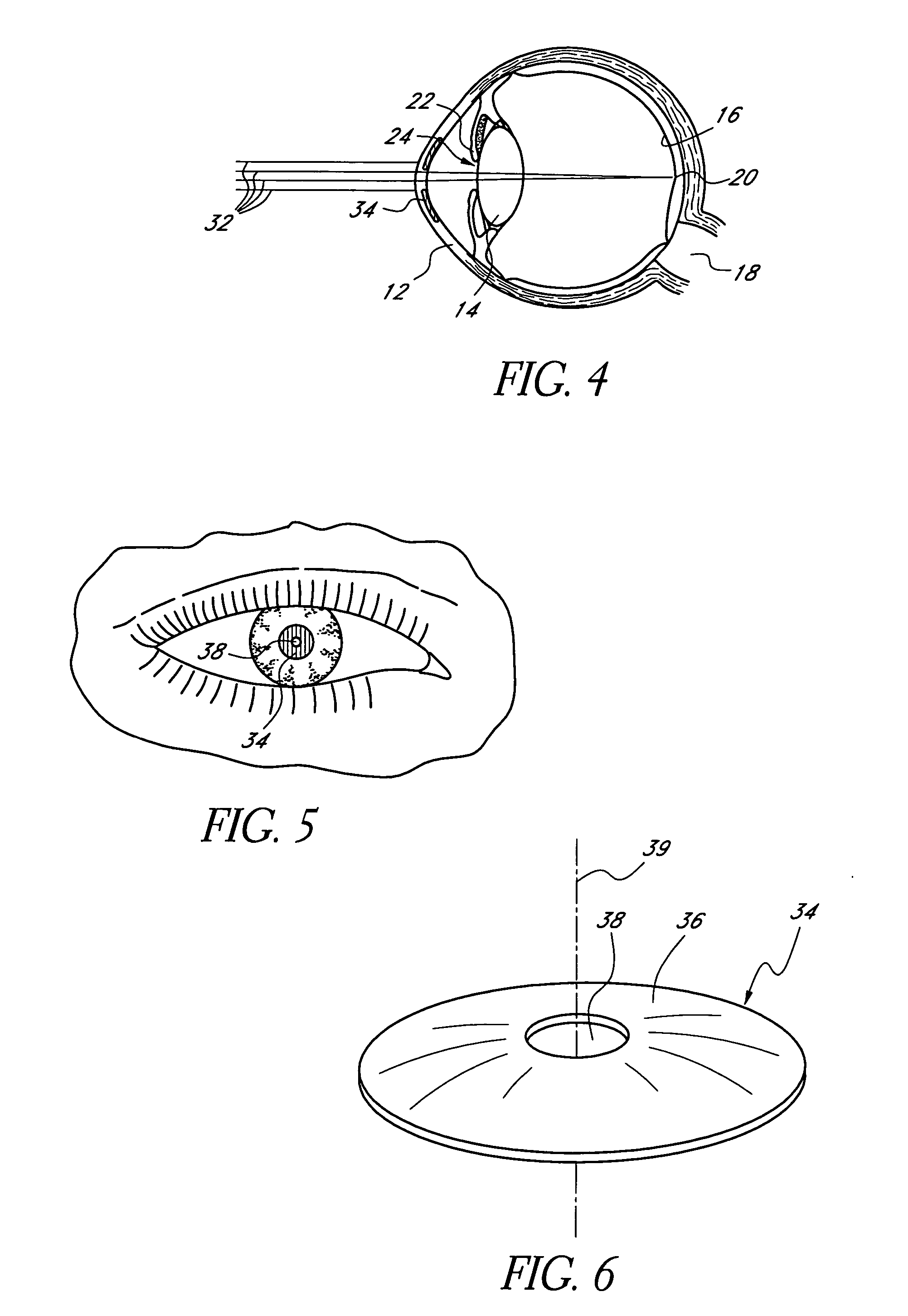 Corneal optic formed of degradation resistant polymer