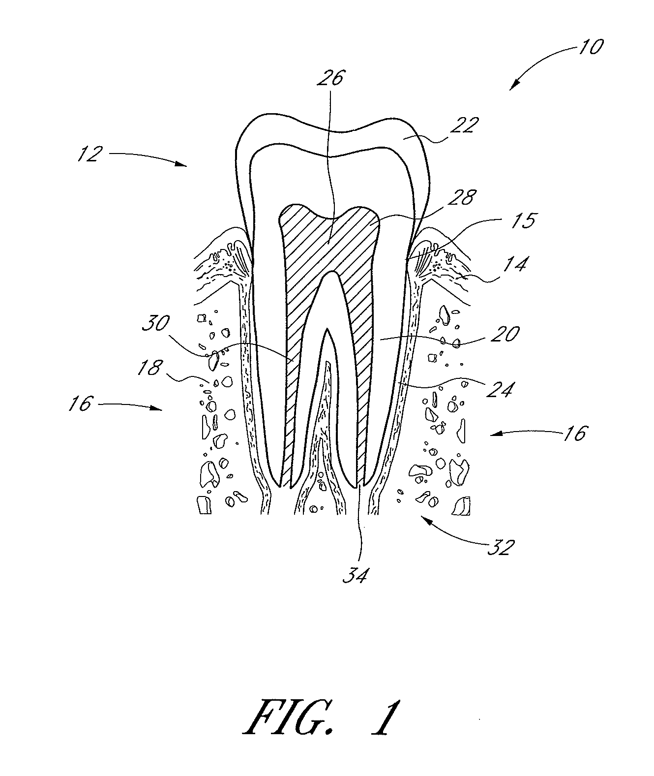 Apparatus and methods for root canal treatments