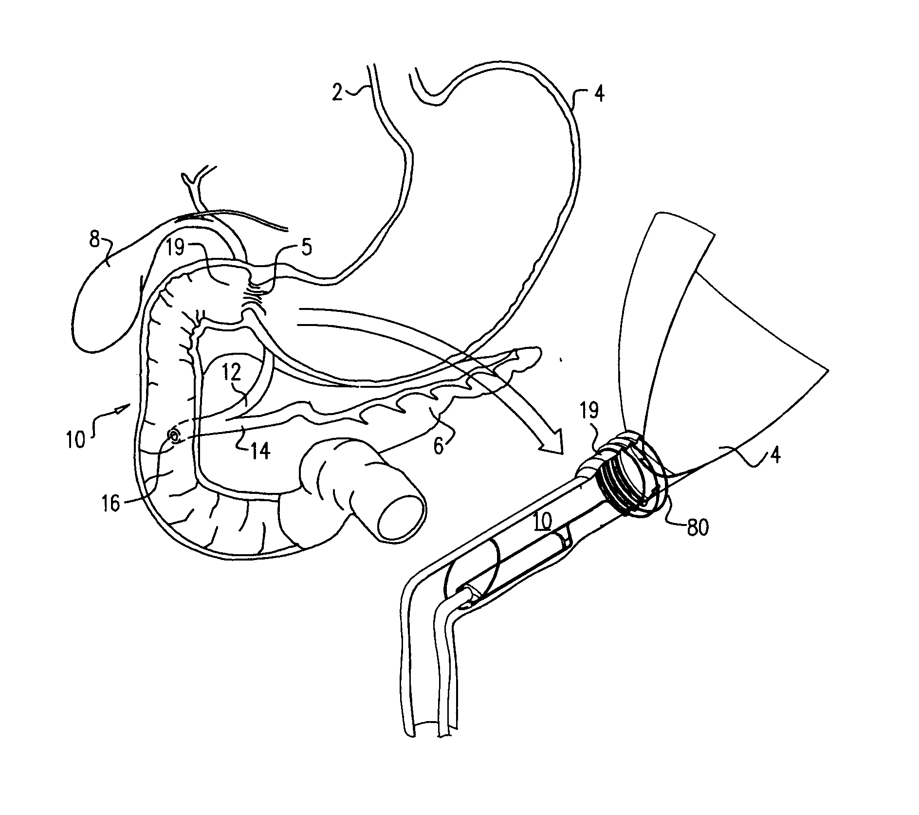 Pancreaticobiliary diversion device