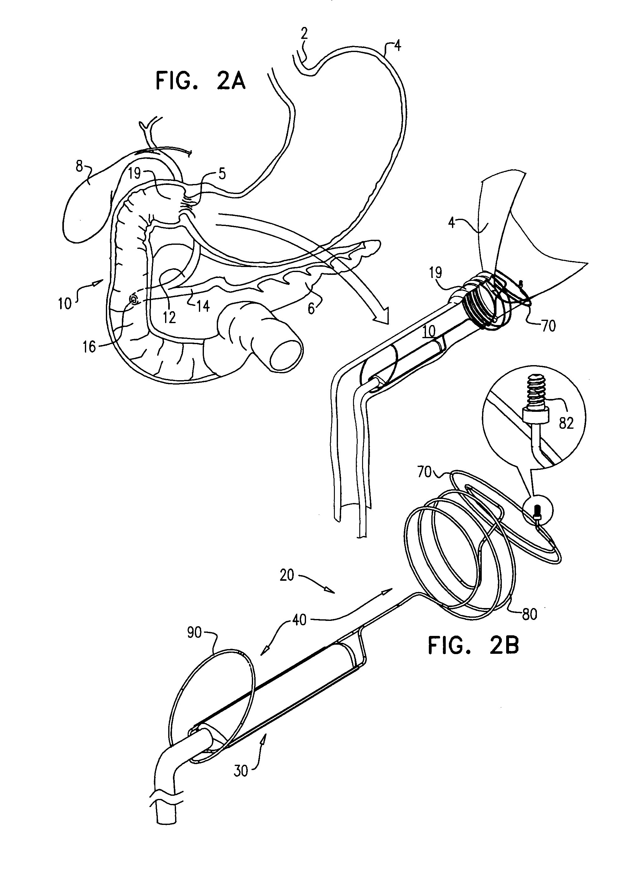 Pancreaticobiliary diversion device