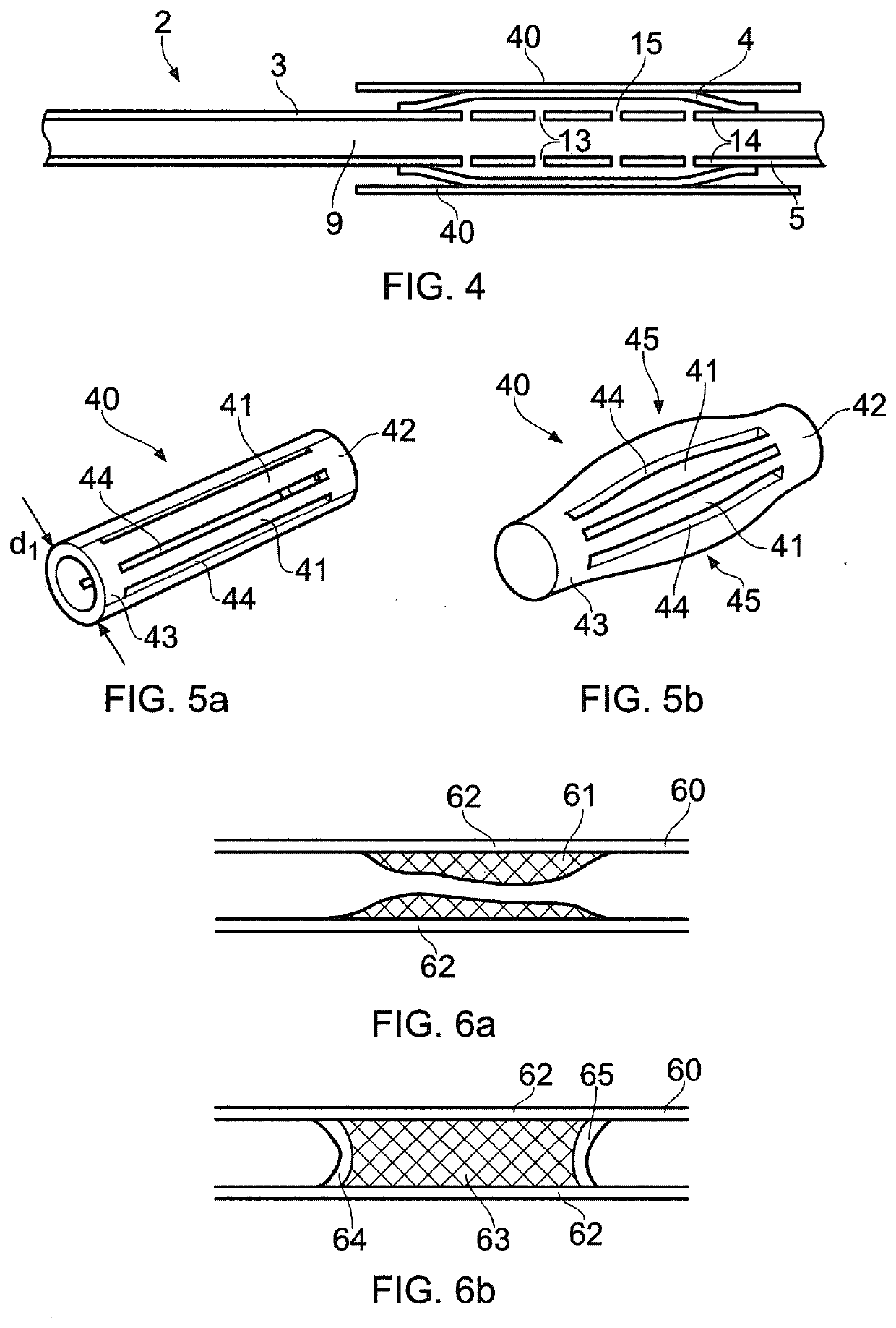 Angioplasty of calcified arteries