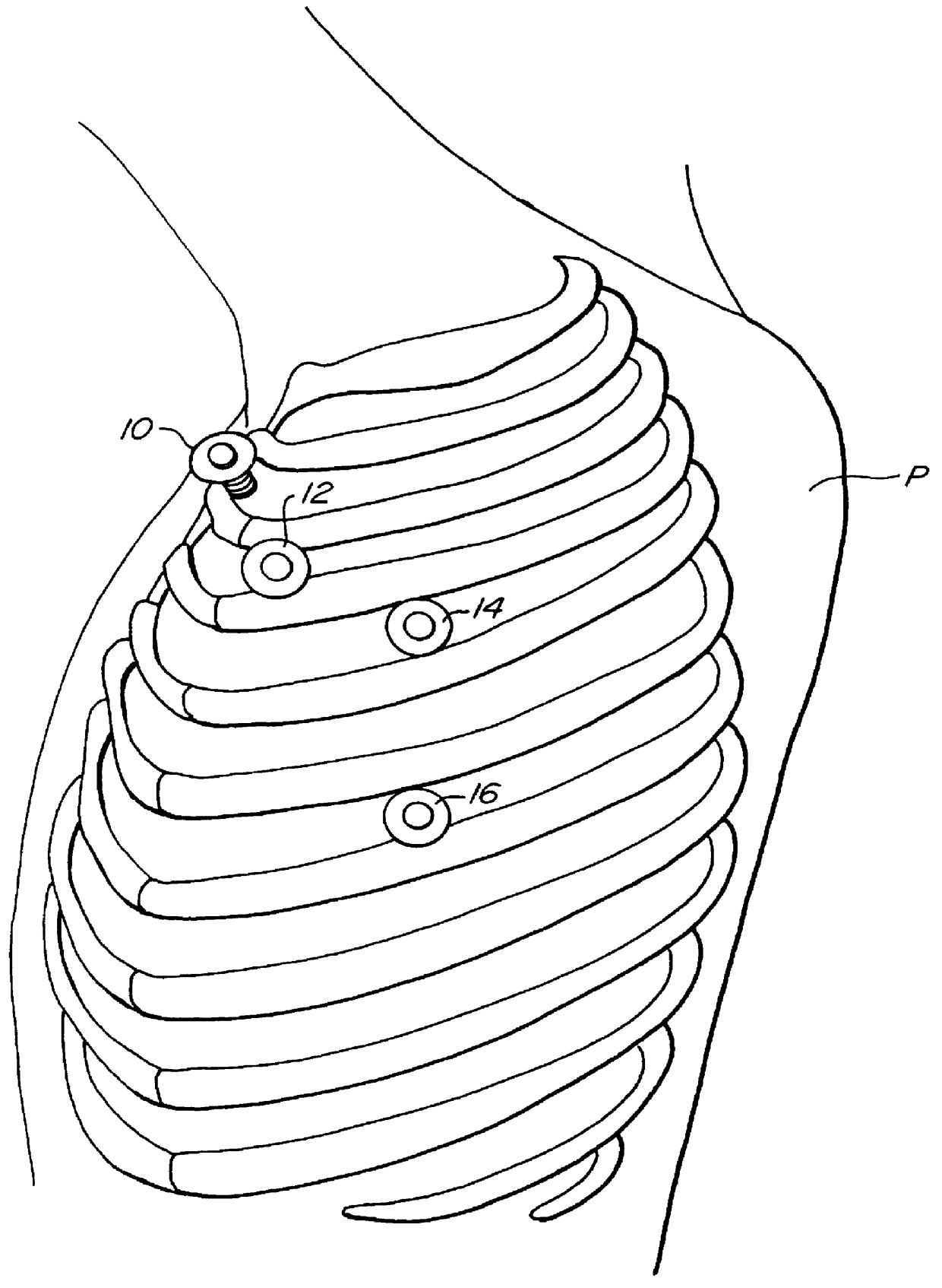 Methods and systems for performing thoracoscopic coronary bypass and other procedures