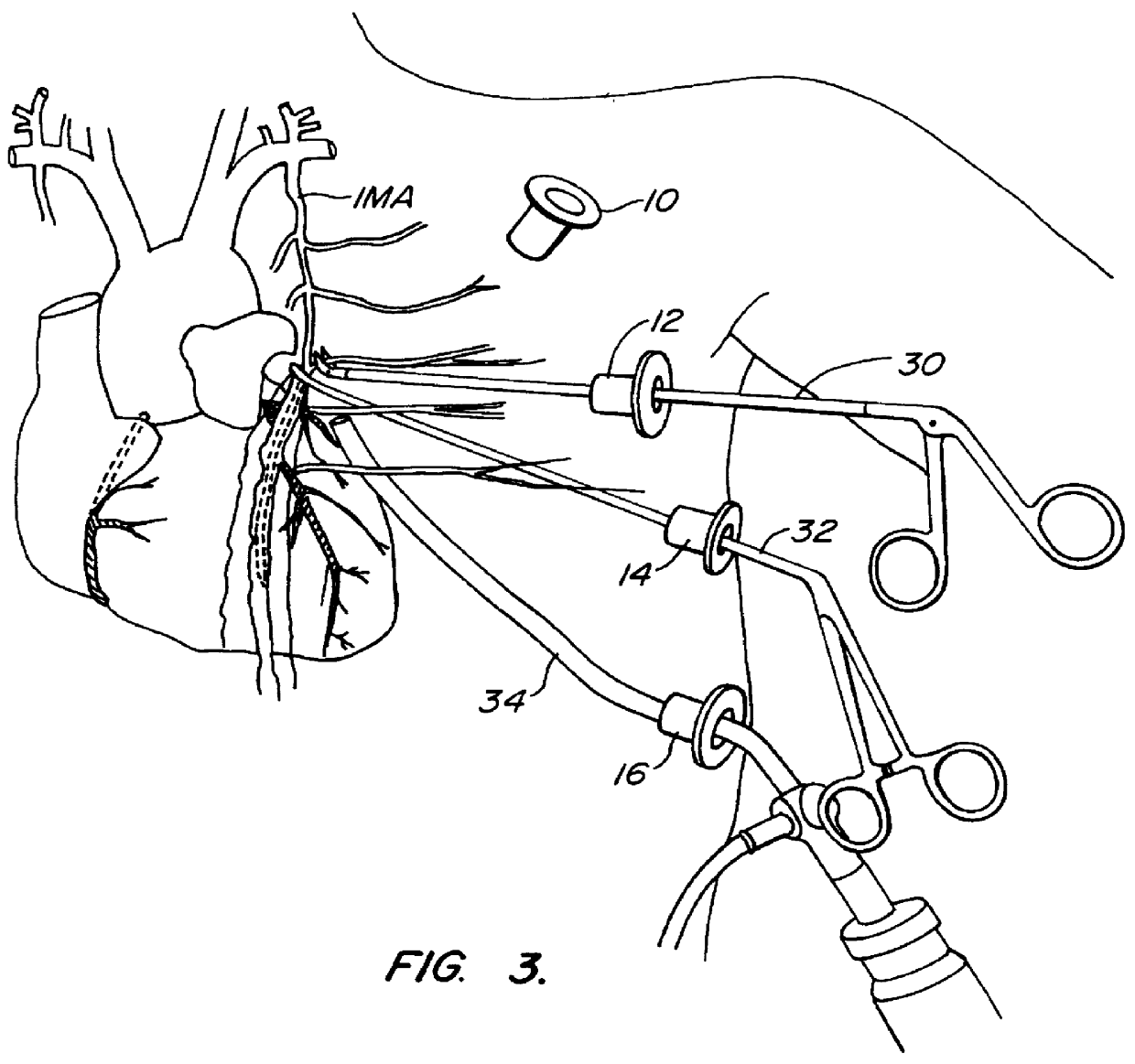 Methods and systems for performing thoracoscopic coronary bypass and other procedures