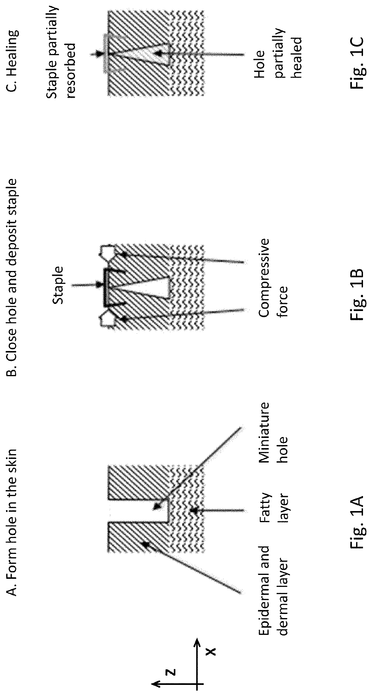 Microclosures and related methods for skin treatment