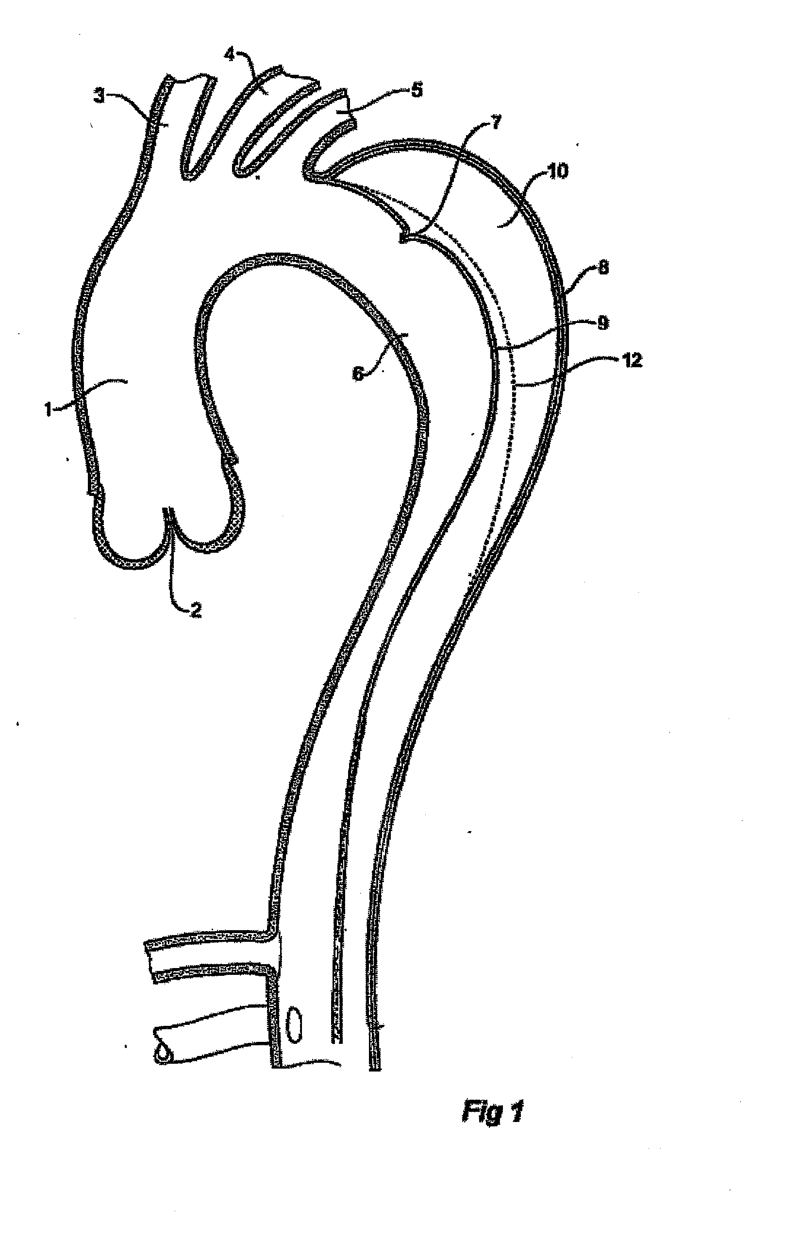 Device and method for treating vascular dissections