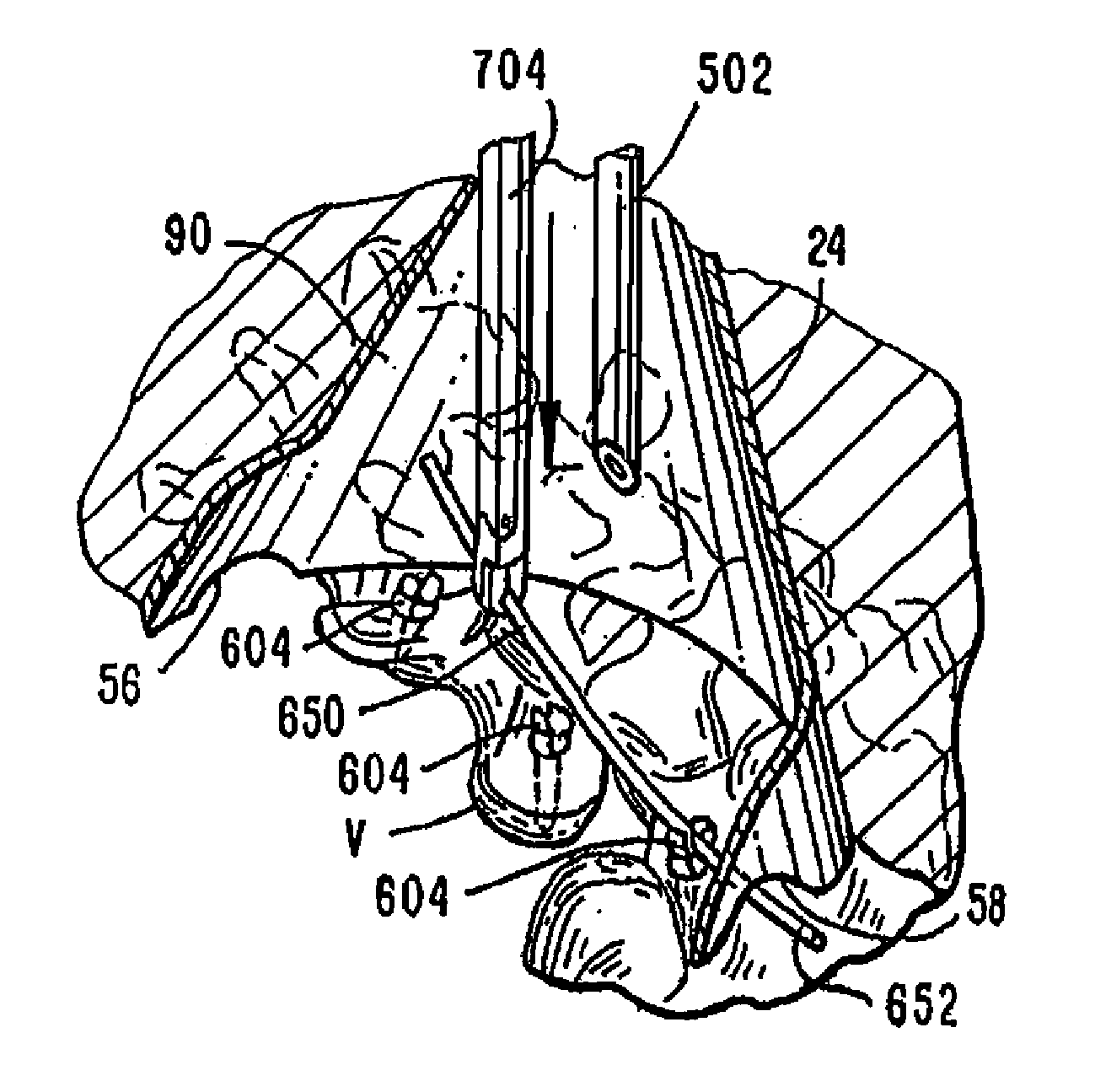 Access device for minimally invasive surgery